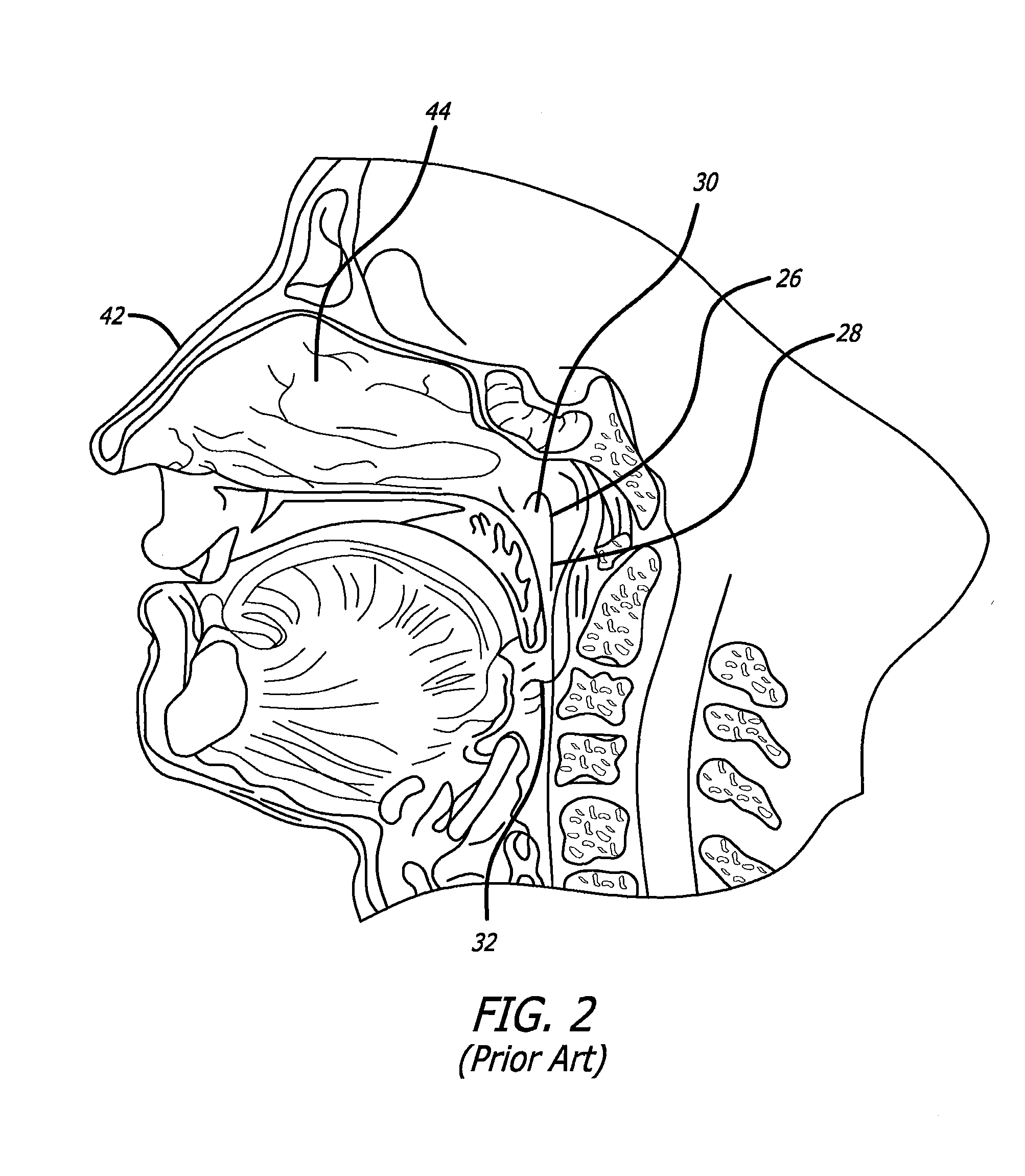 Eustachian tube dilation balloon with ventilation path