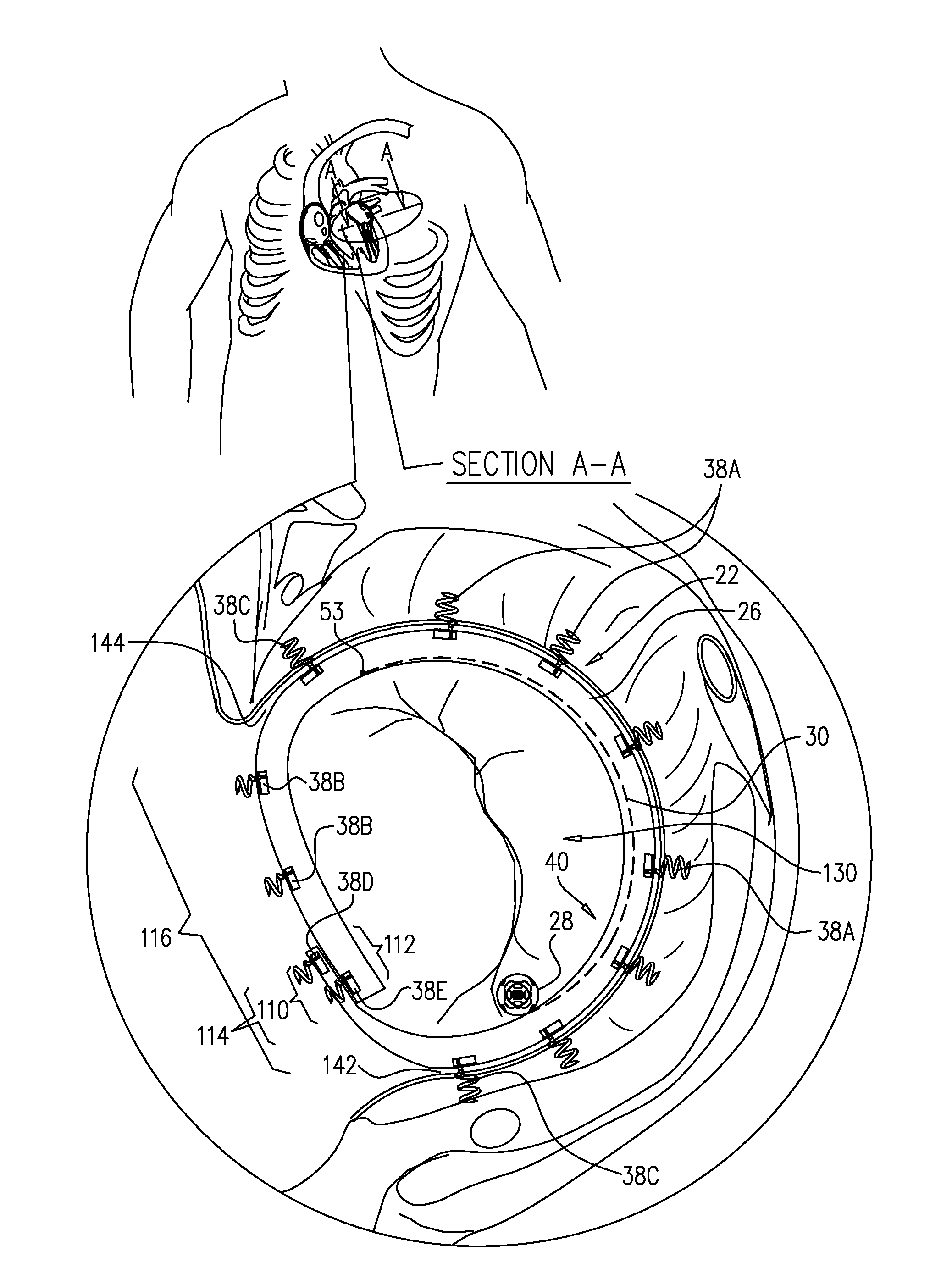 Closed band for percutaneous annuloplasty