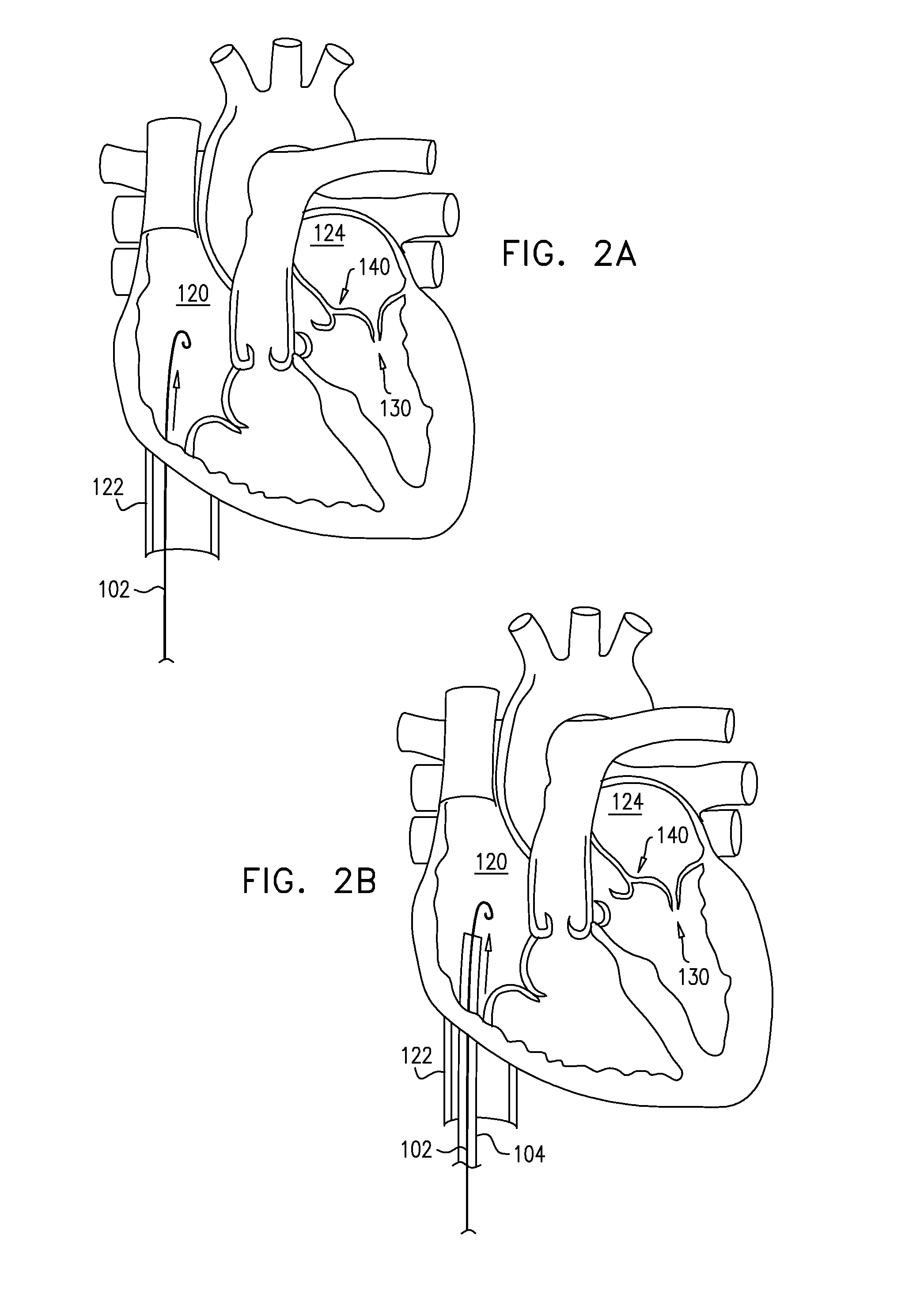 Closed band for percutaneous annuloplasty