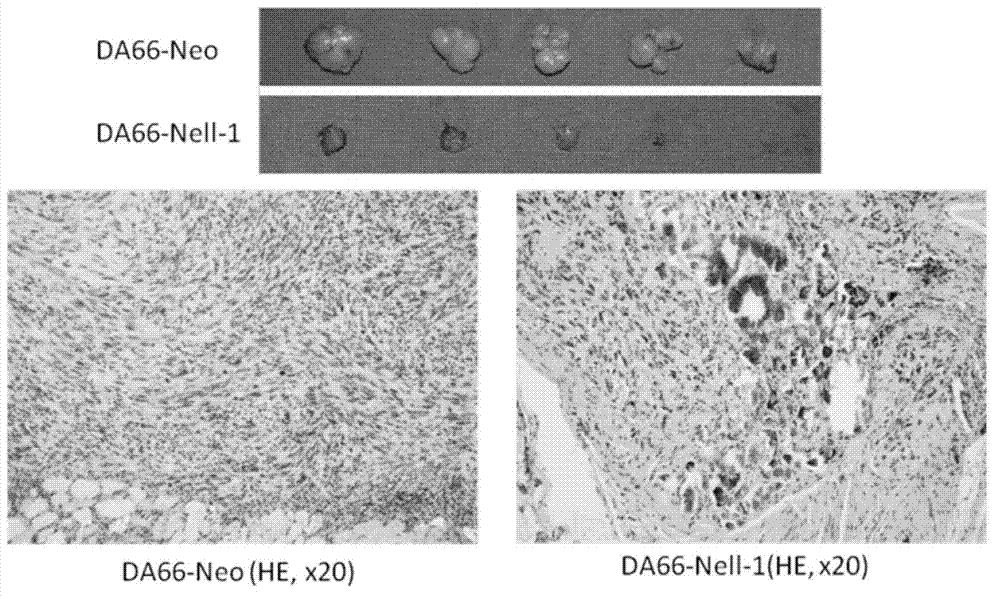 Gene medicine for promoting differentiation of tumor stem cells and applications thereof