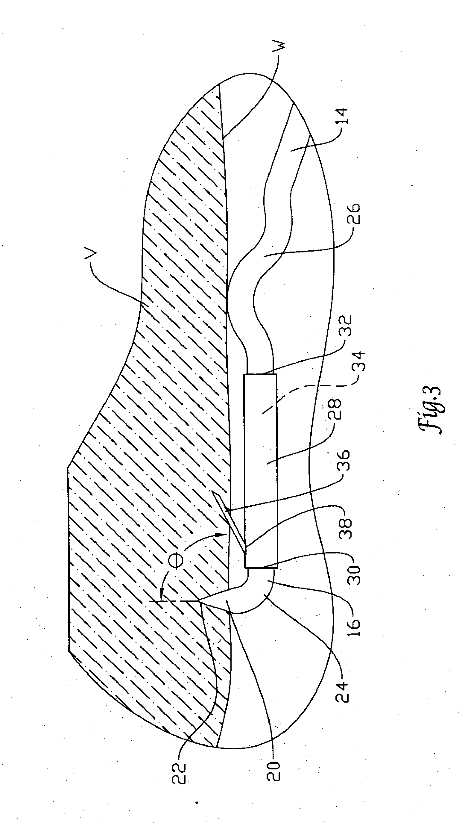 Retrievable ivc filter