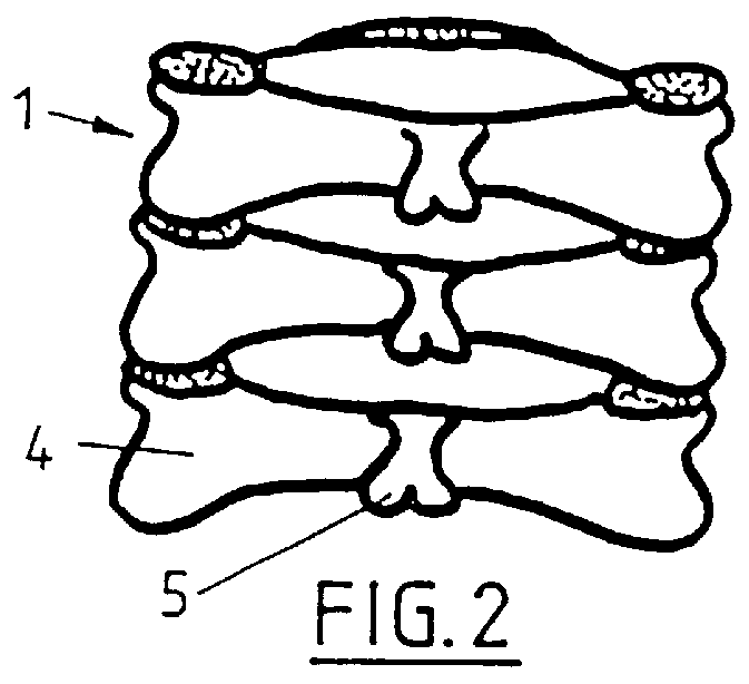 Device to stabilize the lamina