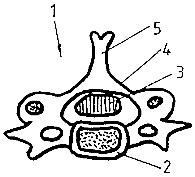 Device to stabilize the lamina