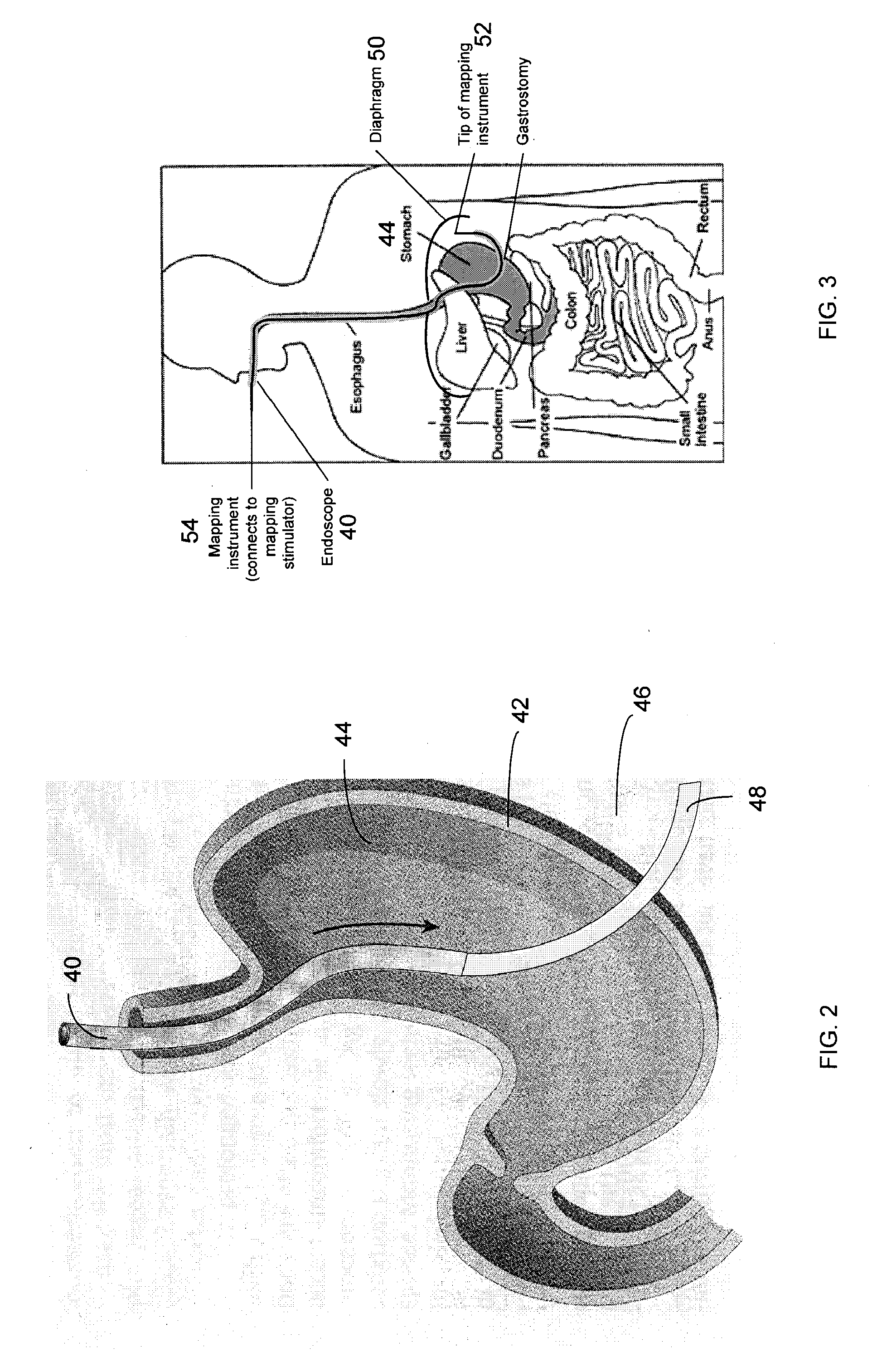 Method And Apparatus For Transgastric Neurostimulation