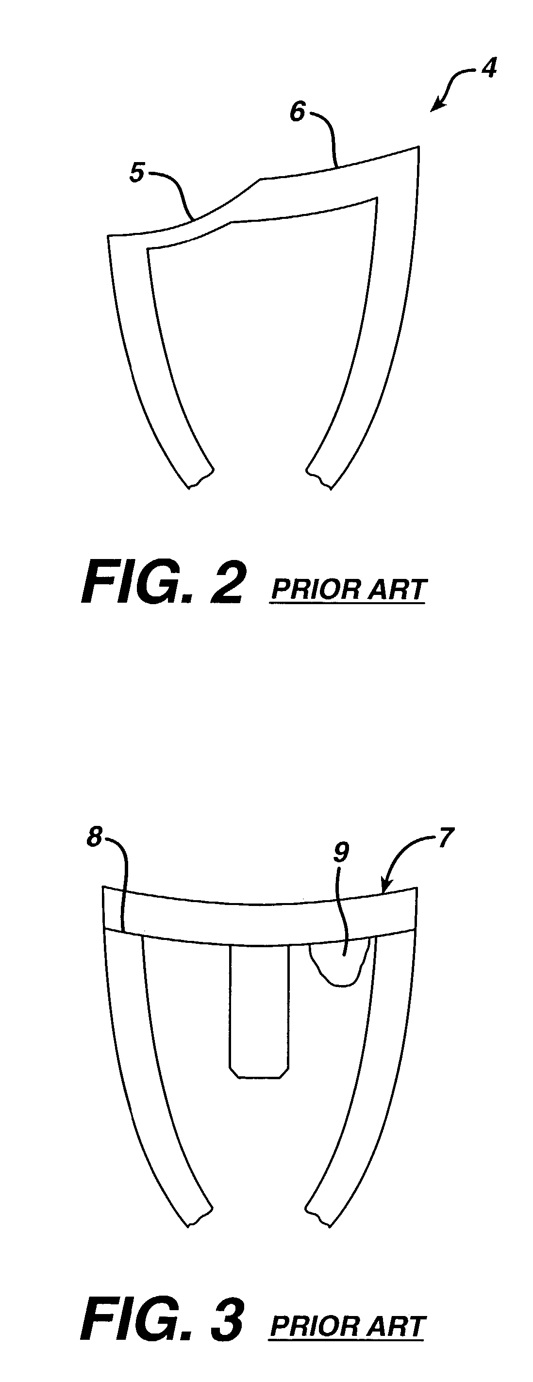 Concave resurfacing prosthesis