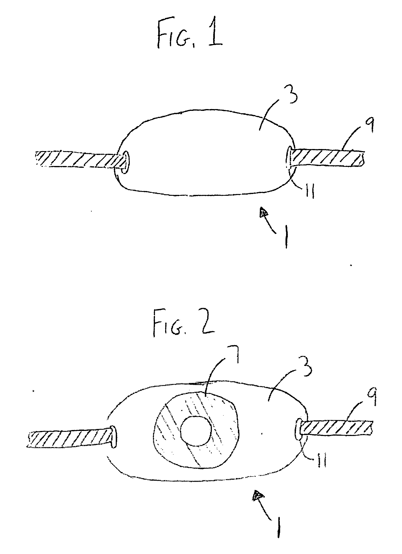 Post decannulation stoma cover