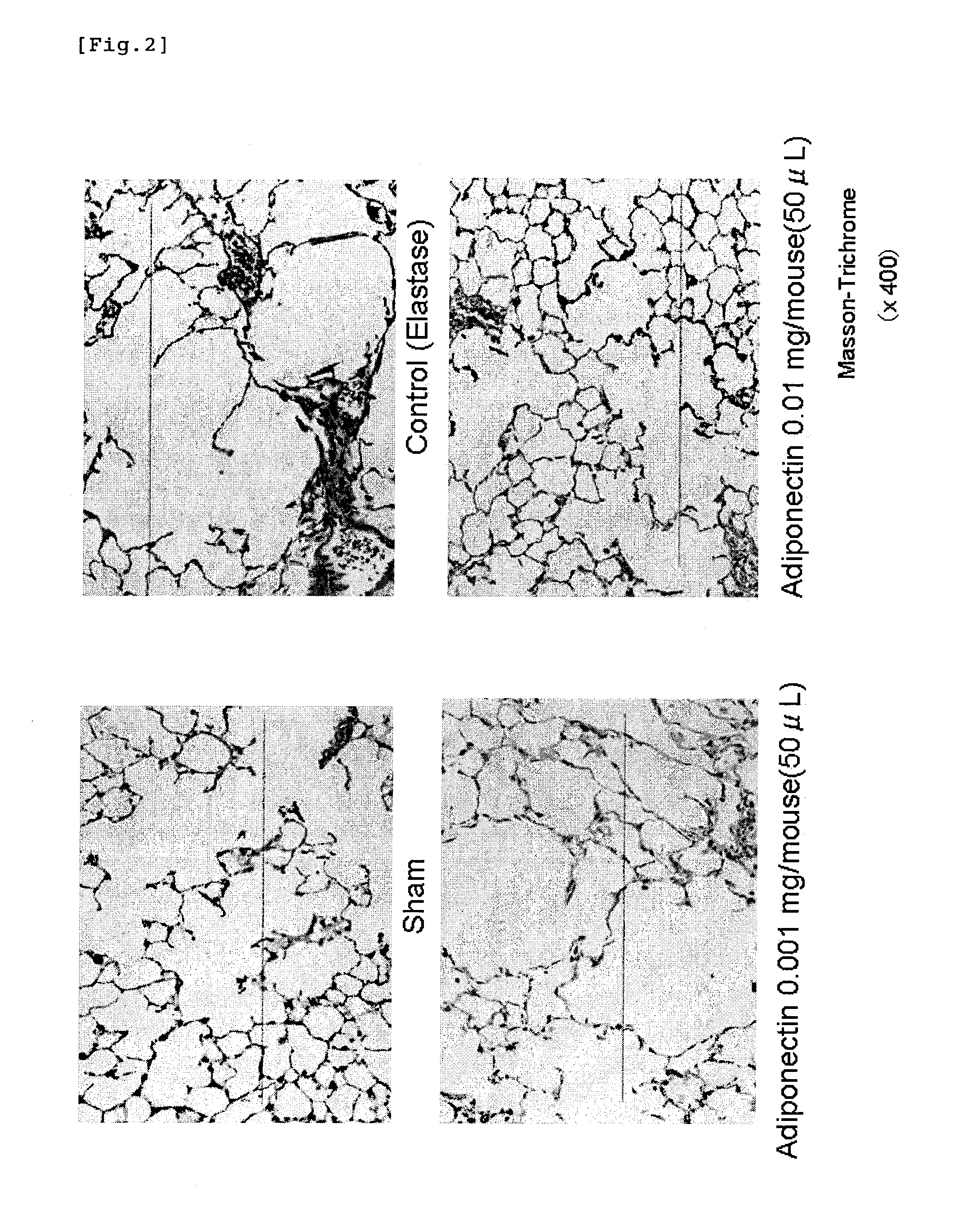 Adiponectin for treating pulmonary disease