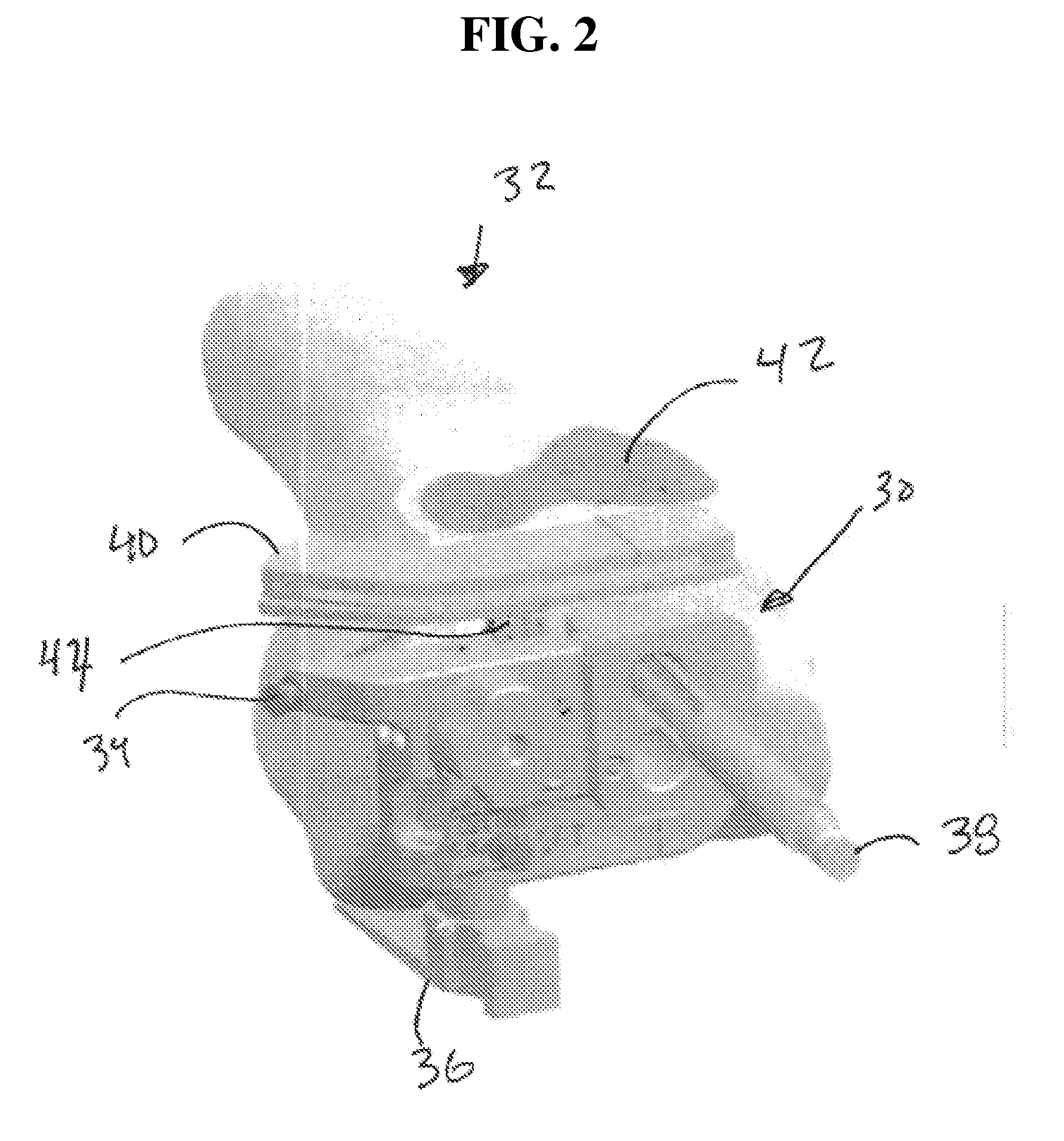 Method and system for computer assisted surgery for bicompartmental knee replacement