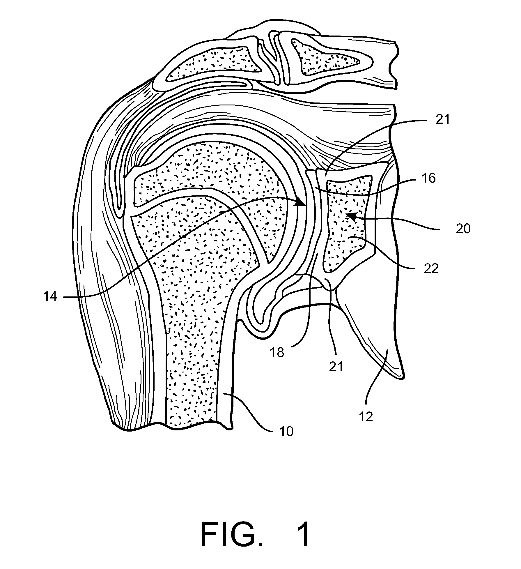 Mobile bearing glenoid prosthesis