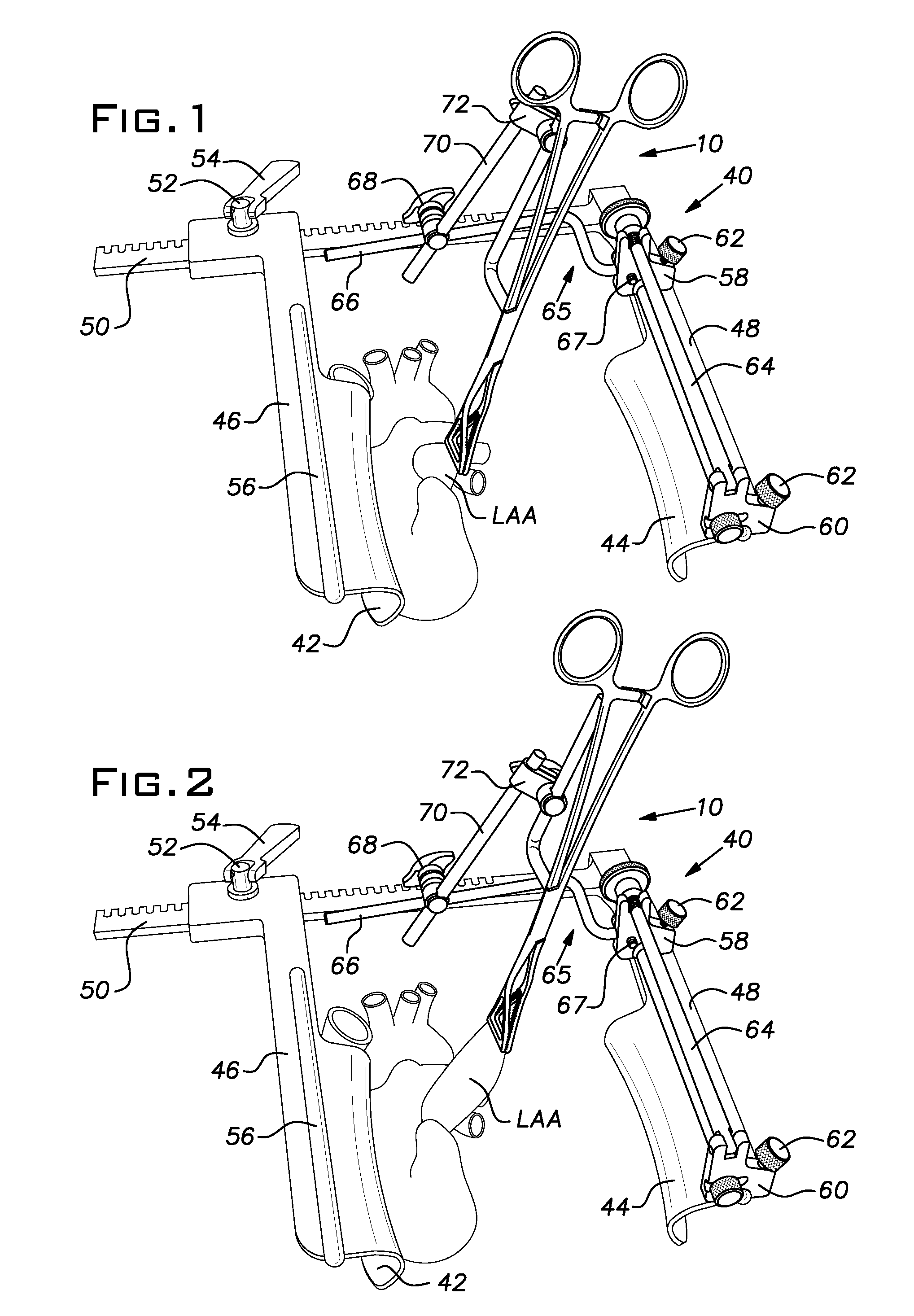 Retraction of the Left Atrial Appendage