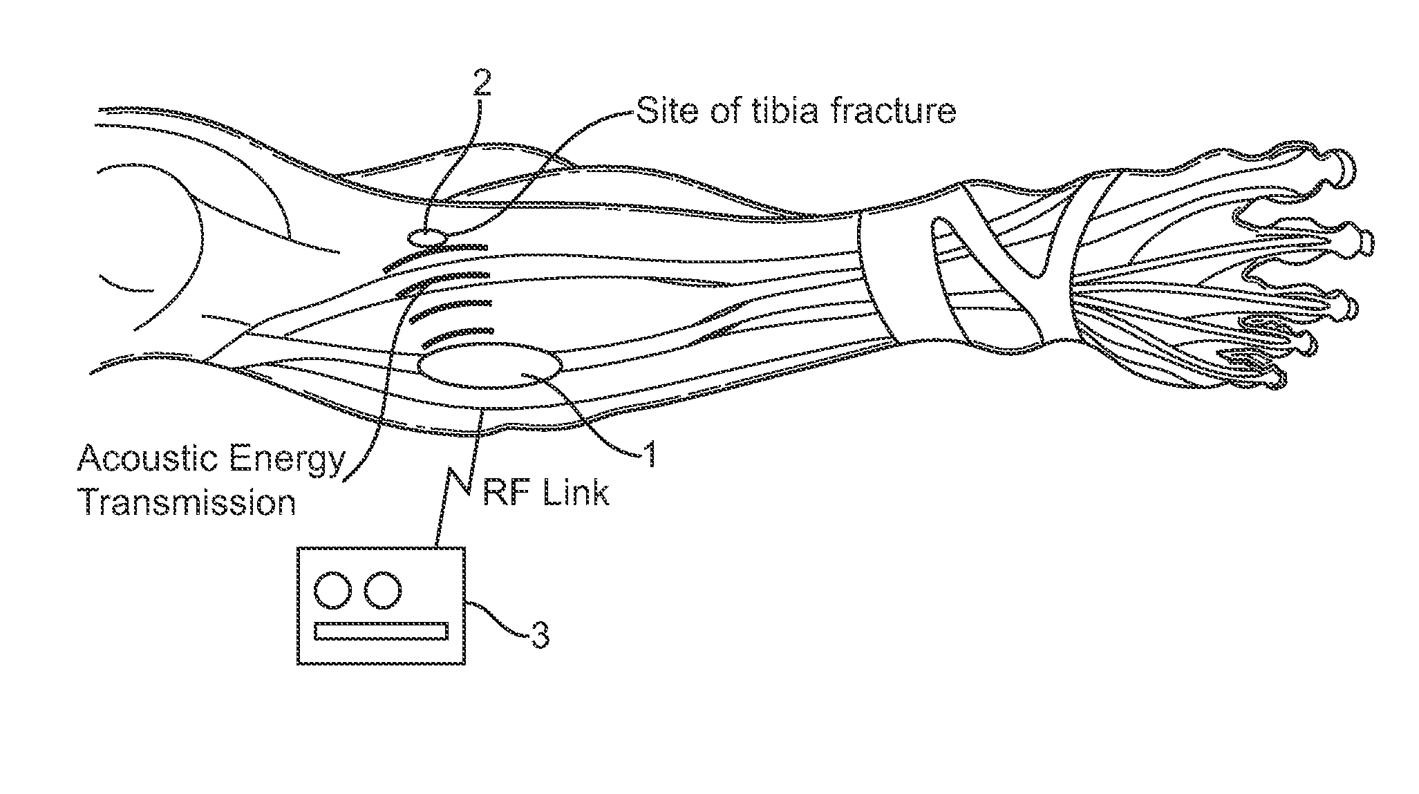 Systems and methods for implantable leadless bone stimulation