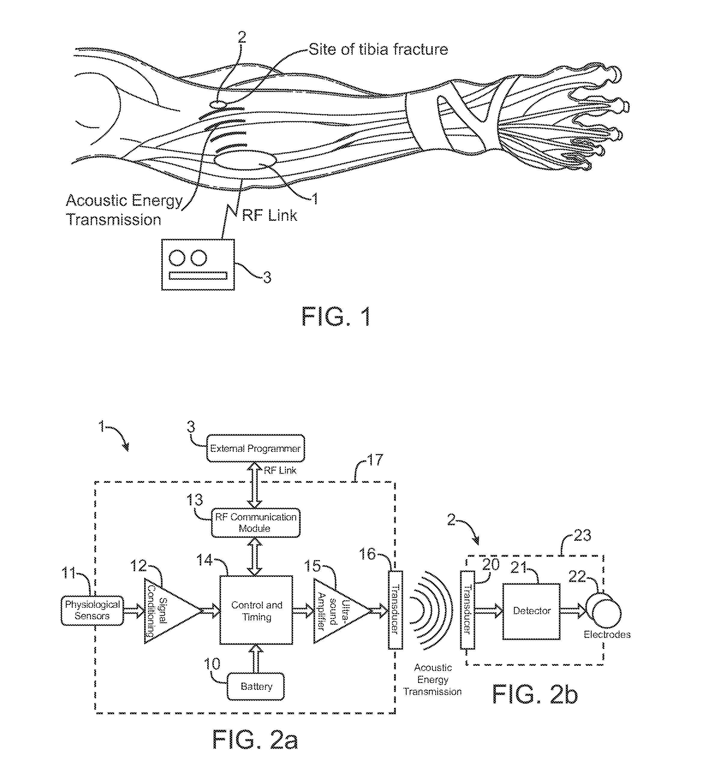 Systems and methods for implantable leadless bone stimulation