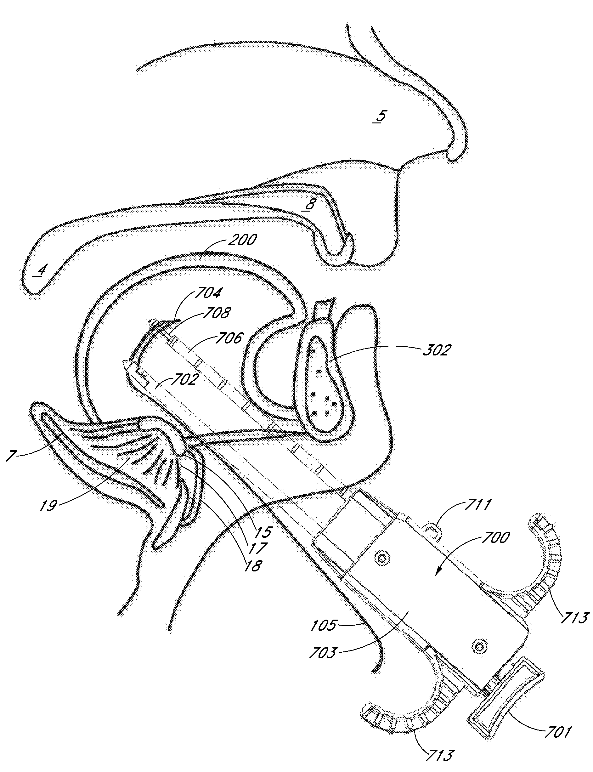 Suture passer systems and methods for tongue or other tissue suspension and compression