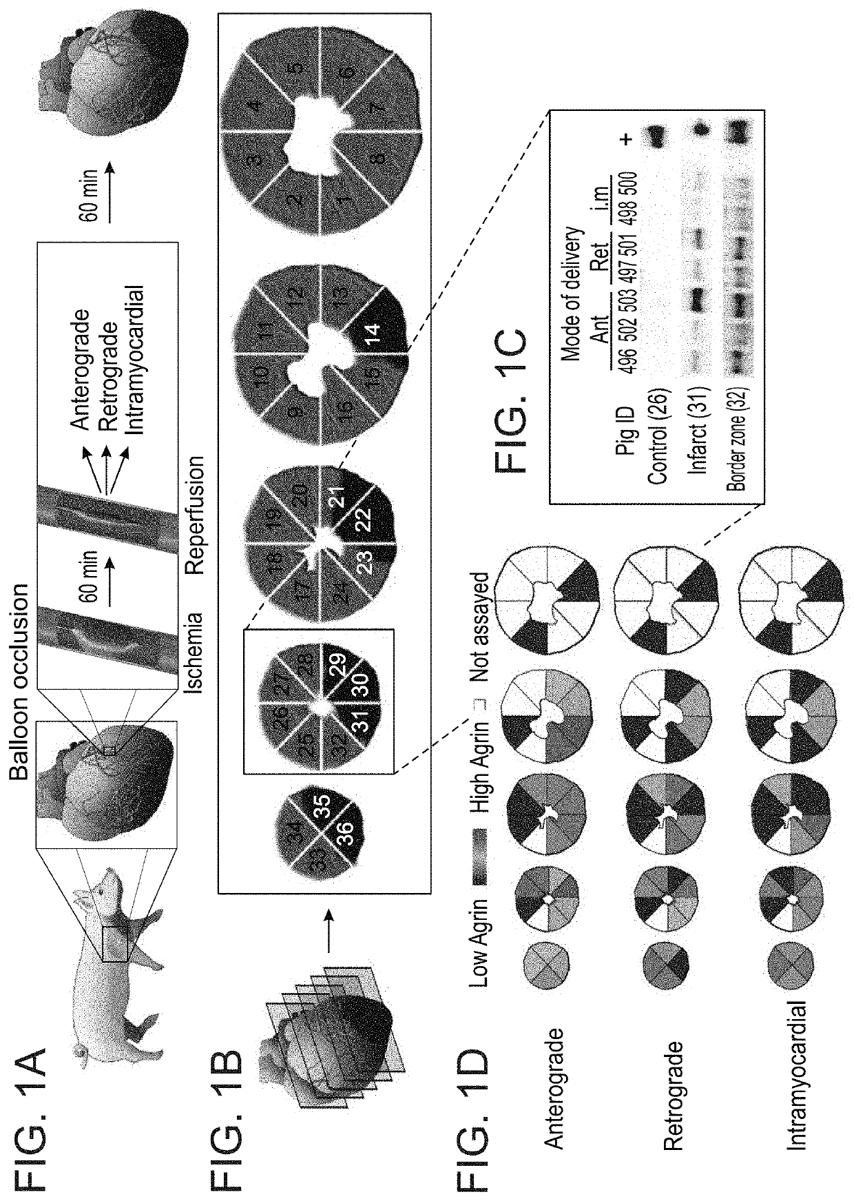 Treatment of an ischemic heart disease