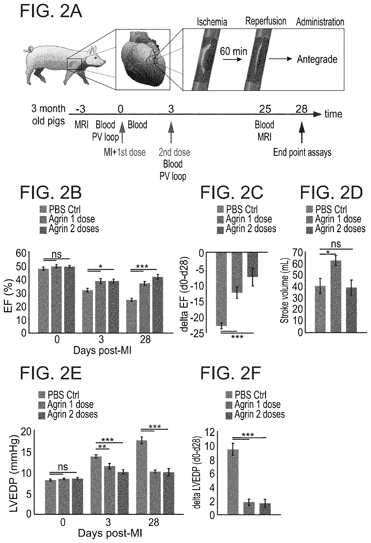 Treatment of an ischemic heart disease