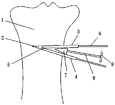 Progressive distracter after gonitis tibial osteotomy