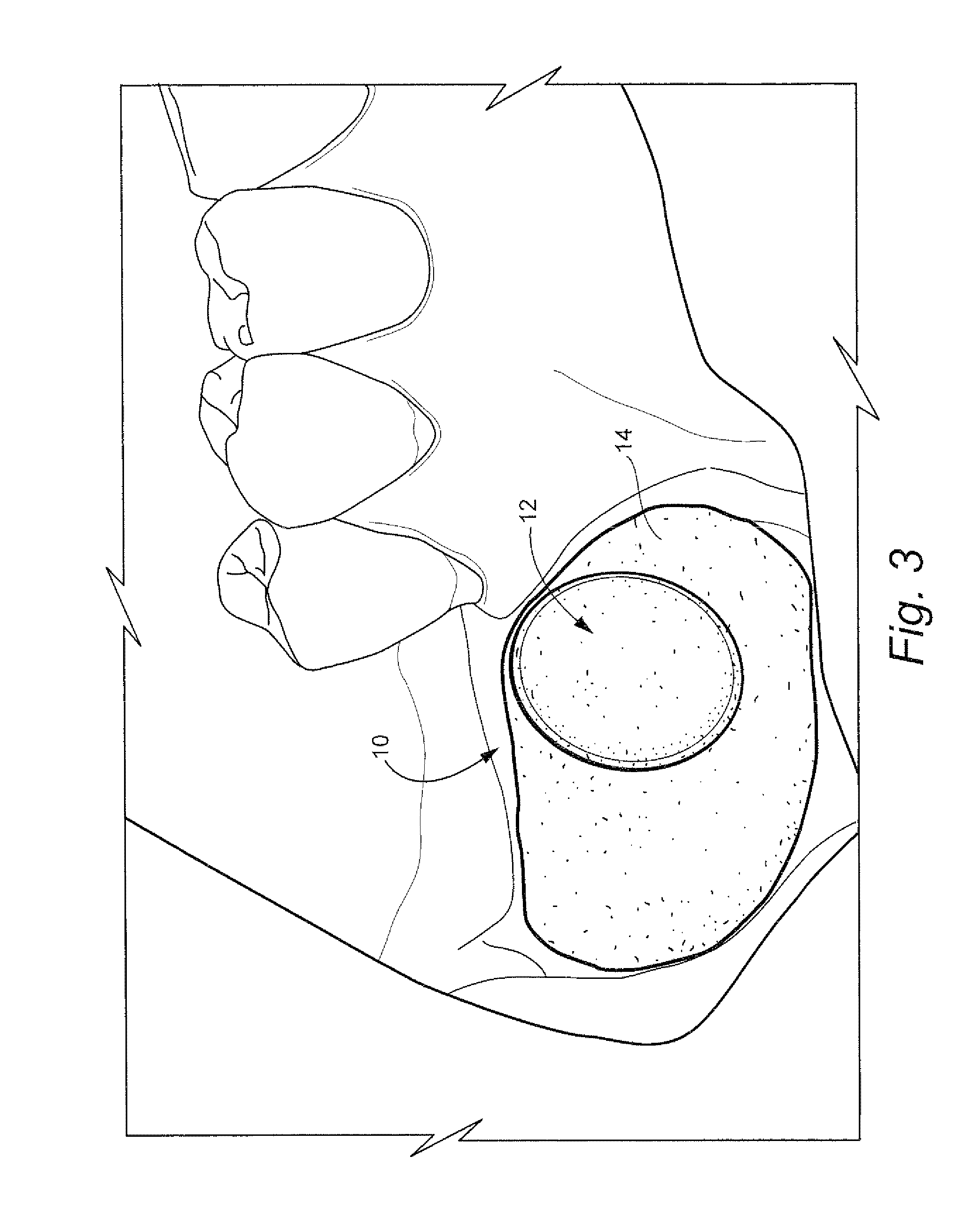 Method for preparing recipient site and implanting allogenic bone graft