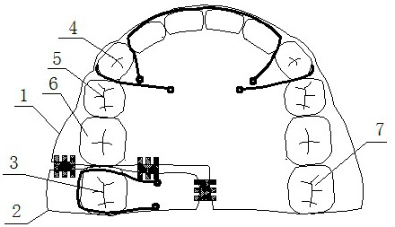 Maxillary occlusal pad type molar retractor in the replacement dentition period