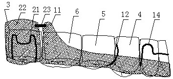 Maxillary occlusal pad type molar retractor in the replacement dentition period