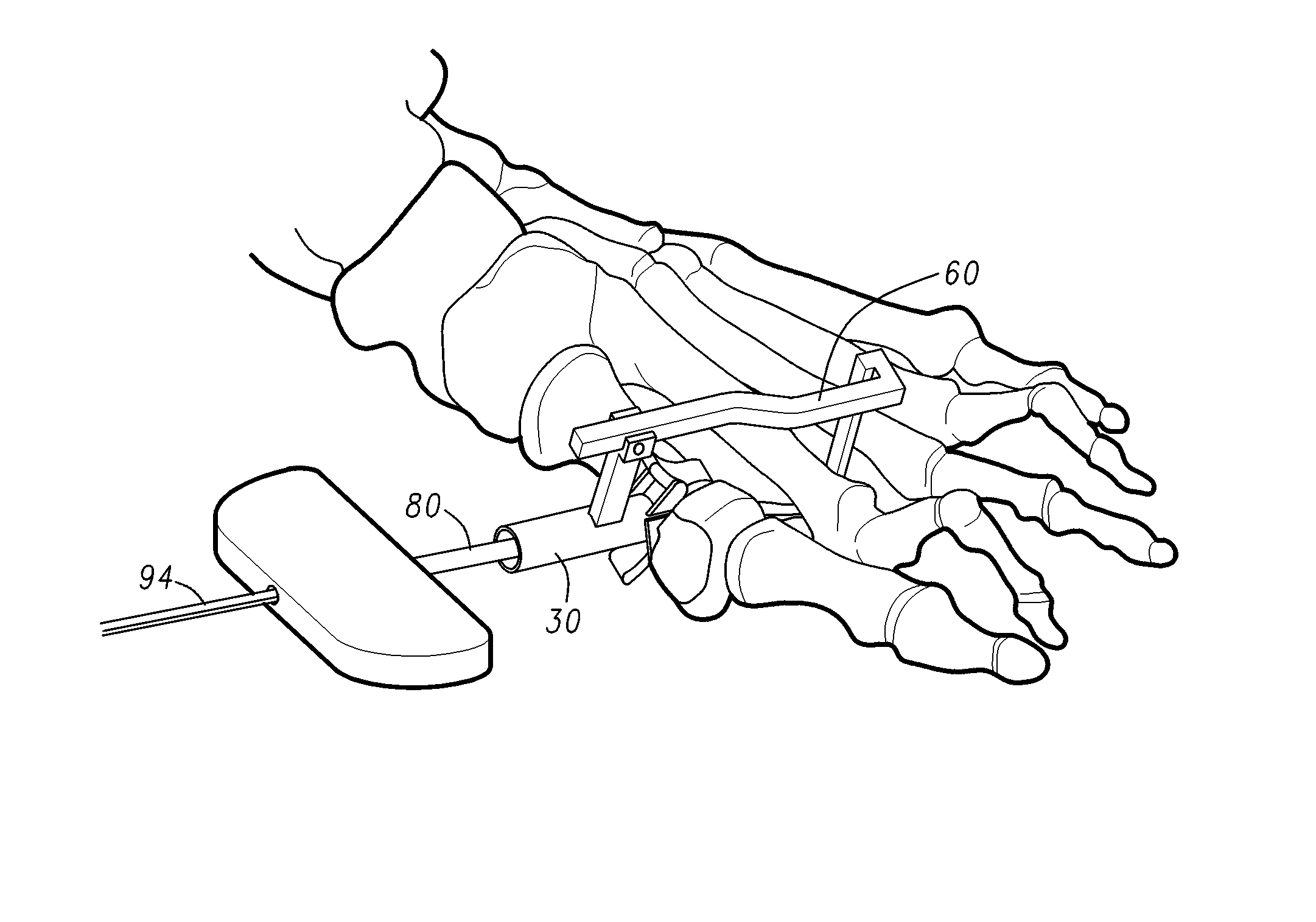 Methods and devices for treating a structural bone and joint deformity