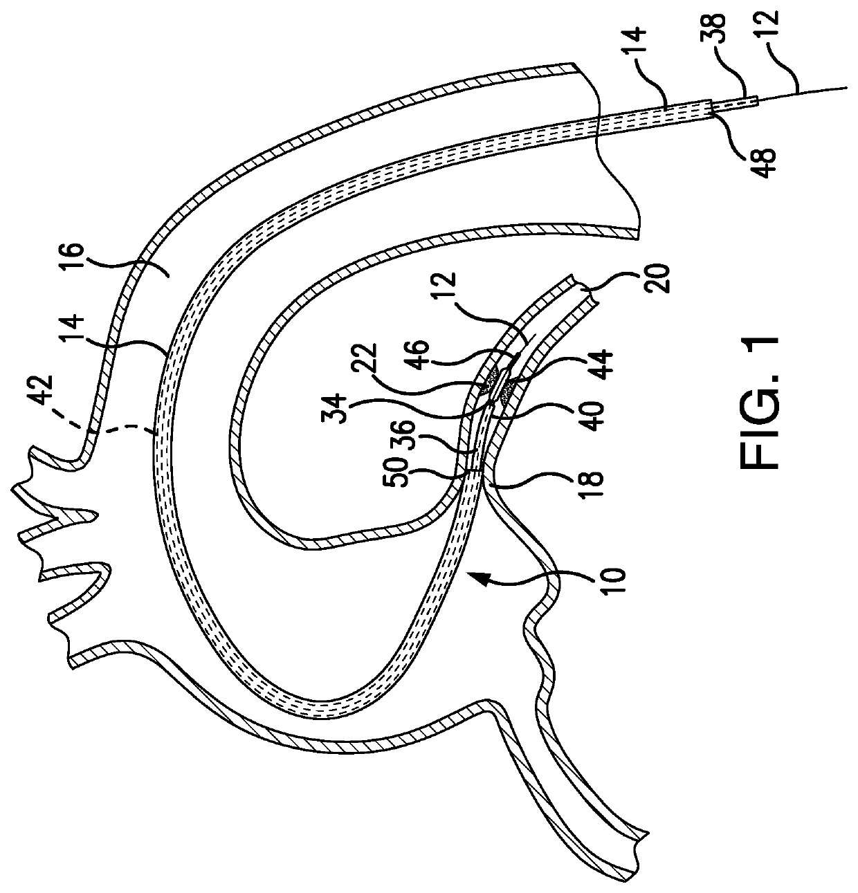 Intravascular delivery system and method for percutaneous coronary intervention