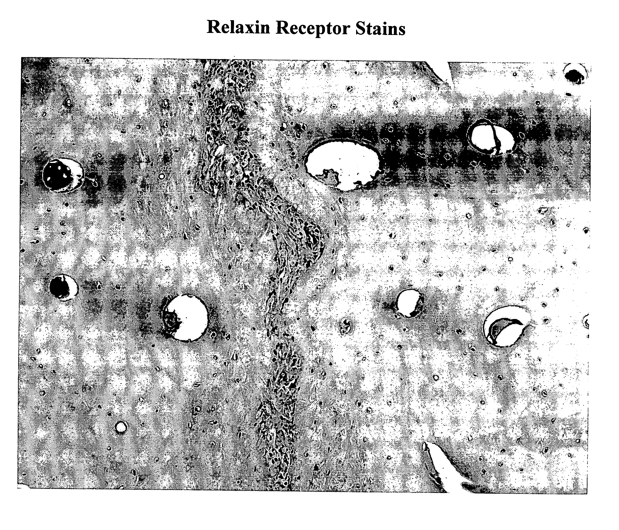 Method for remodeling bone and related sutures