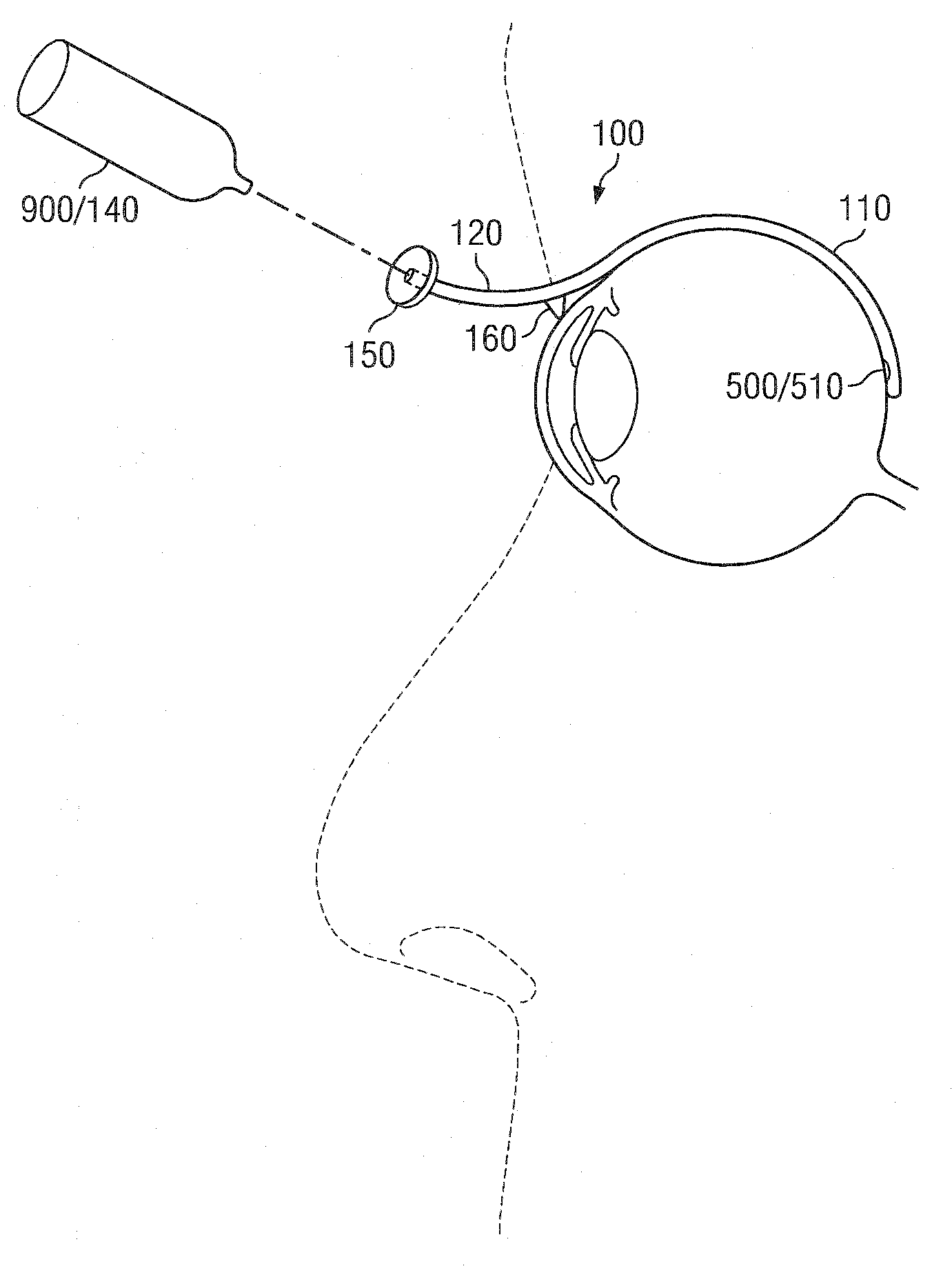 Methods And Devices For Minimally-Invasive Extraocular Delivery of Radiation To The Posterior Portion Of The Eye