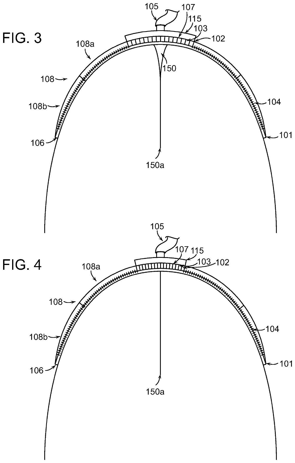 Negative pressure wound closure devices and methods