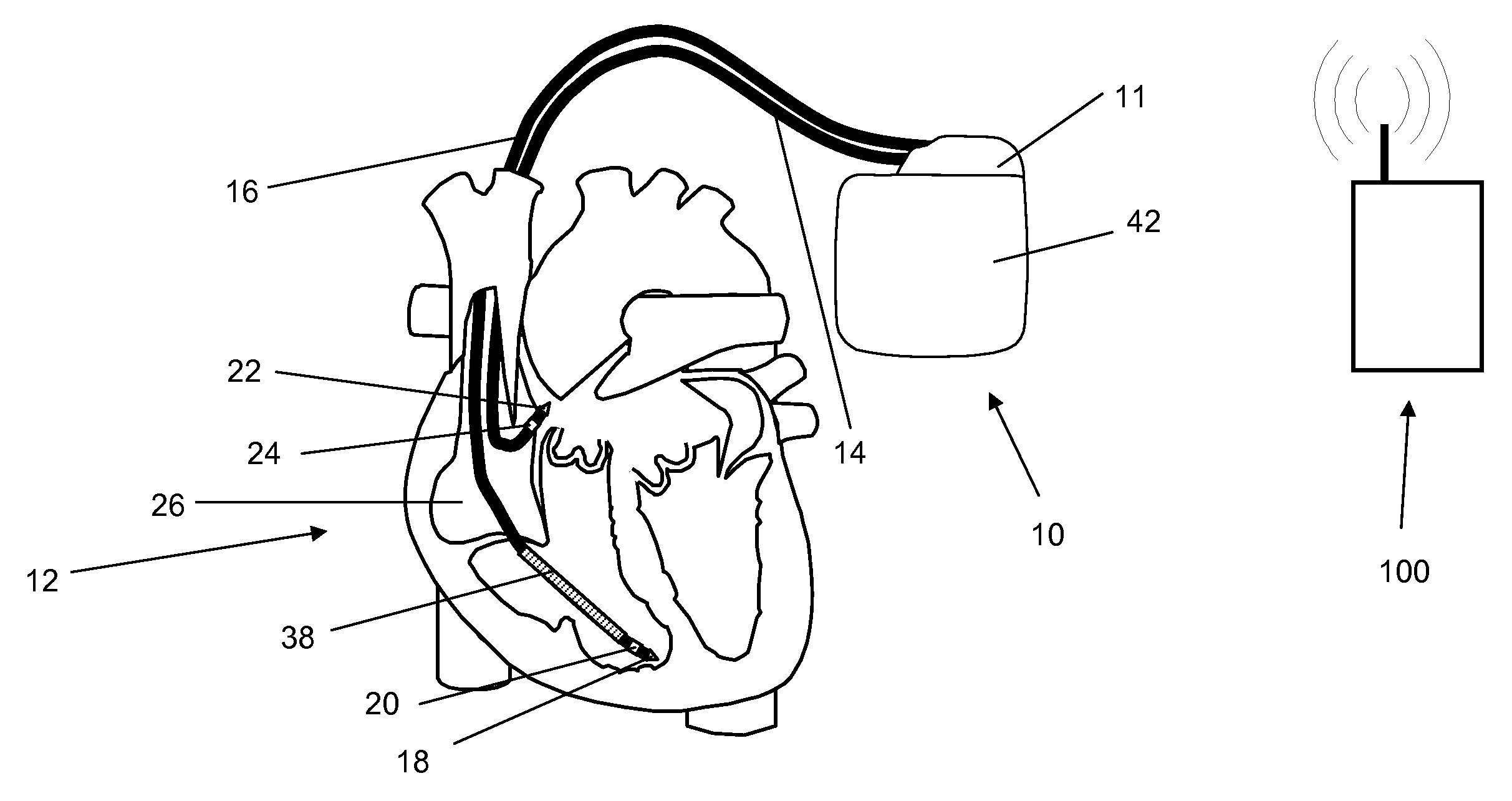 Antitachycardiac heart stimulator