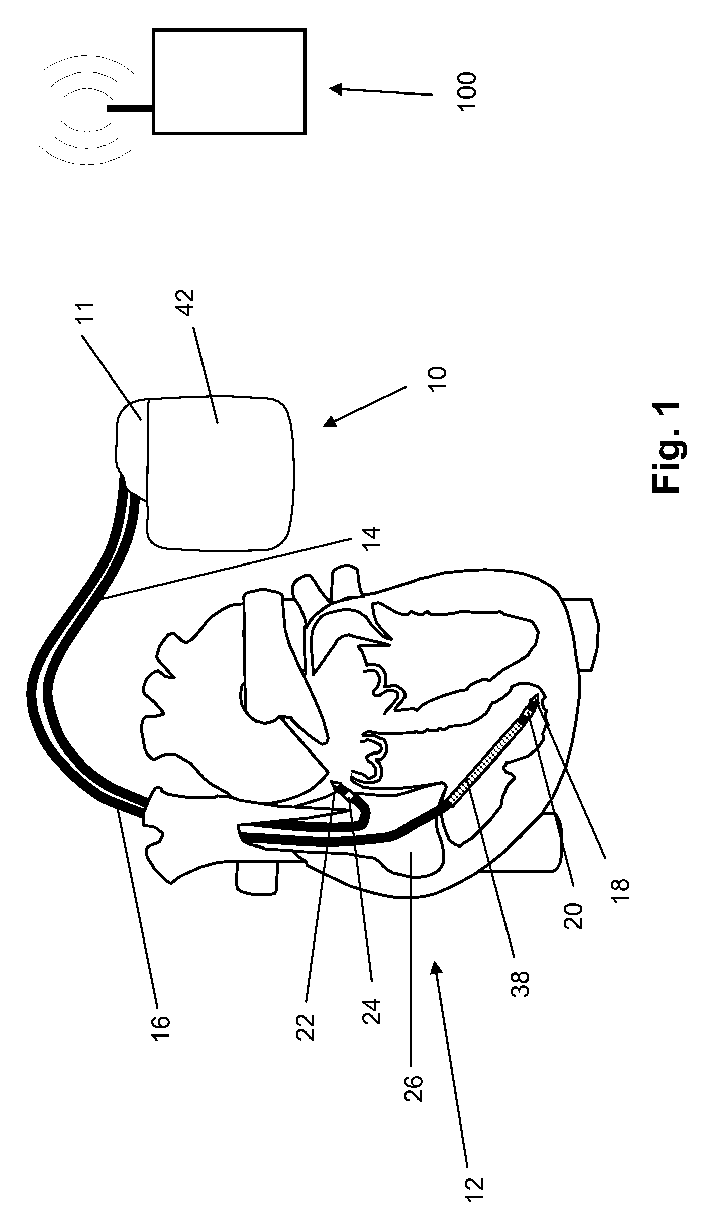 Antitachycardiac heart stimulator