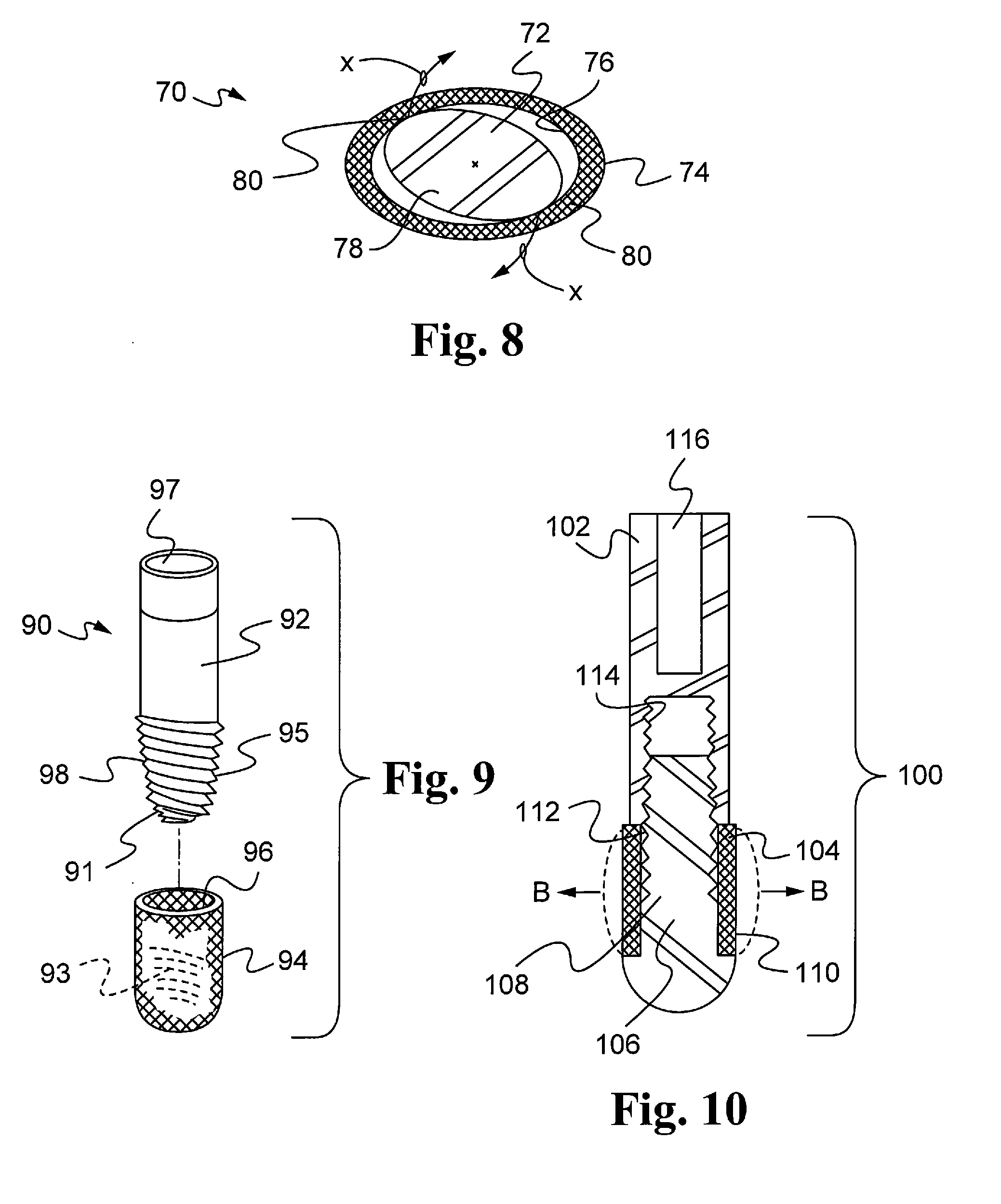 Expandable Bone Implant