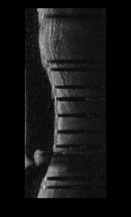 Coronary artery endovascular stent detection method and system based on OCT (Optical Coherence Tomography) image