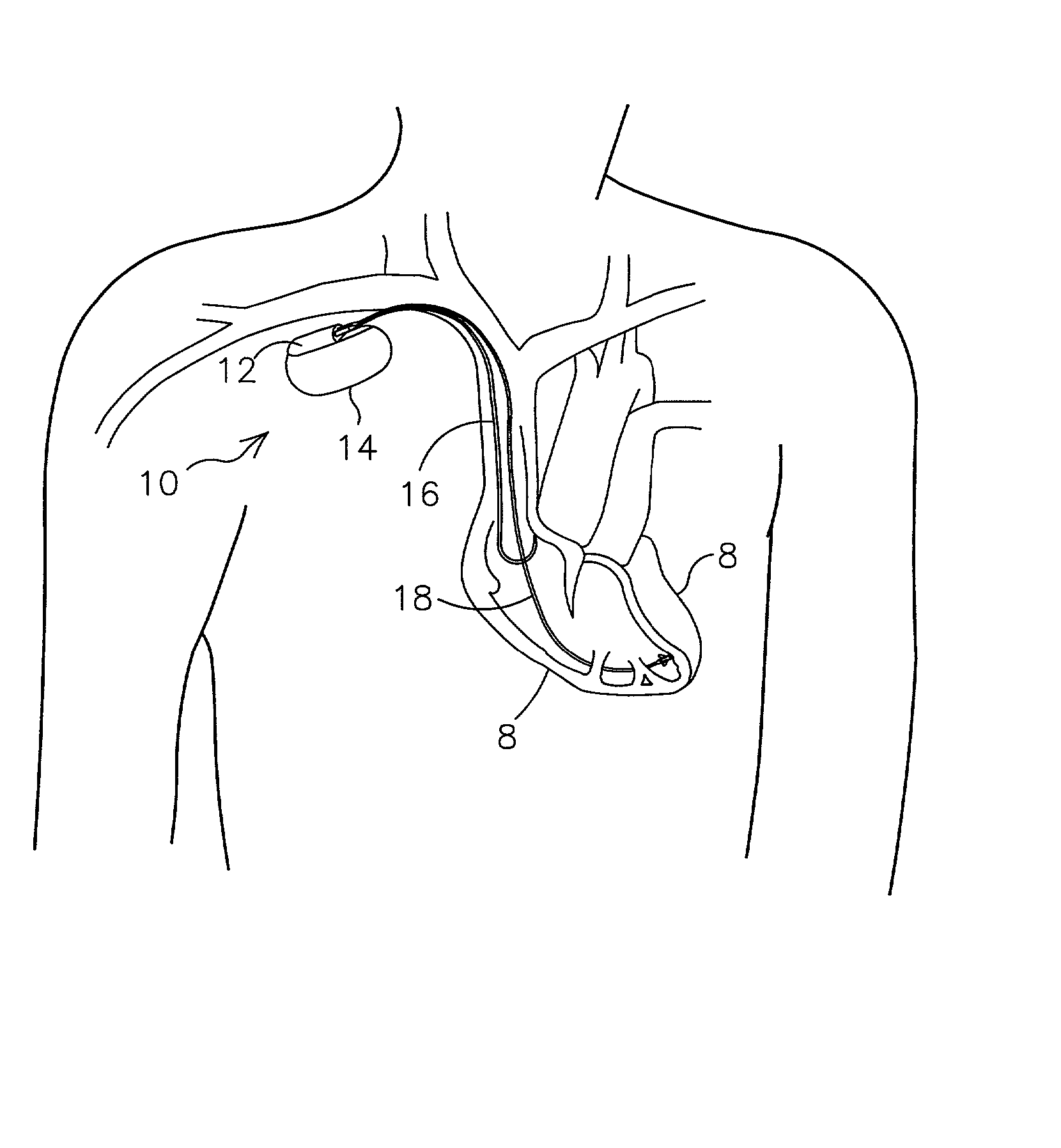 Methods for adjusting cardiac detection criteria and implantable medical devices using same