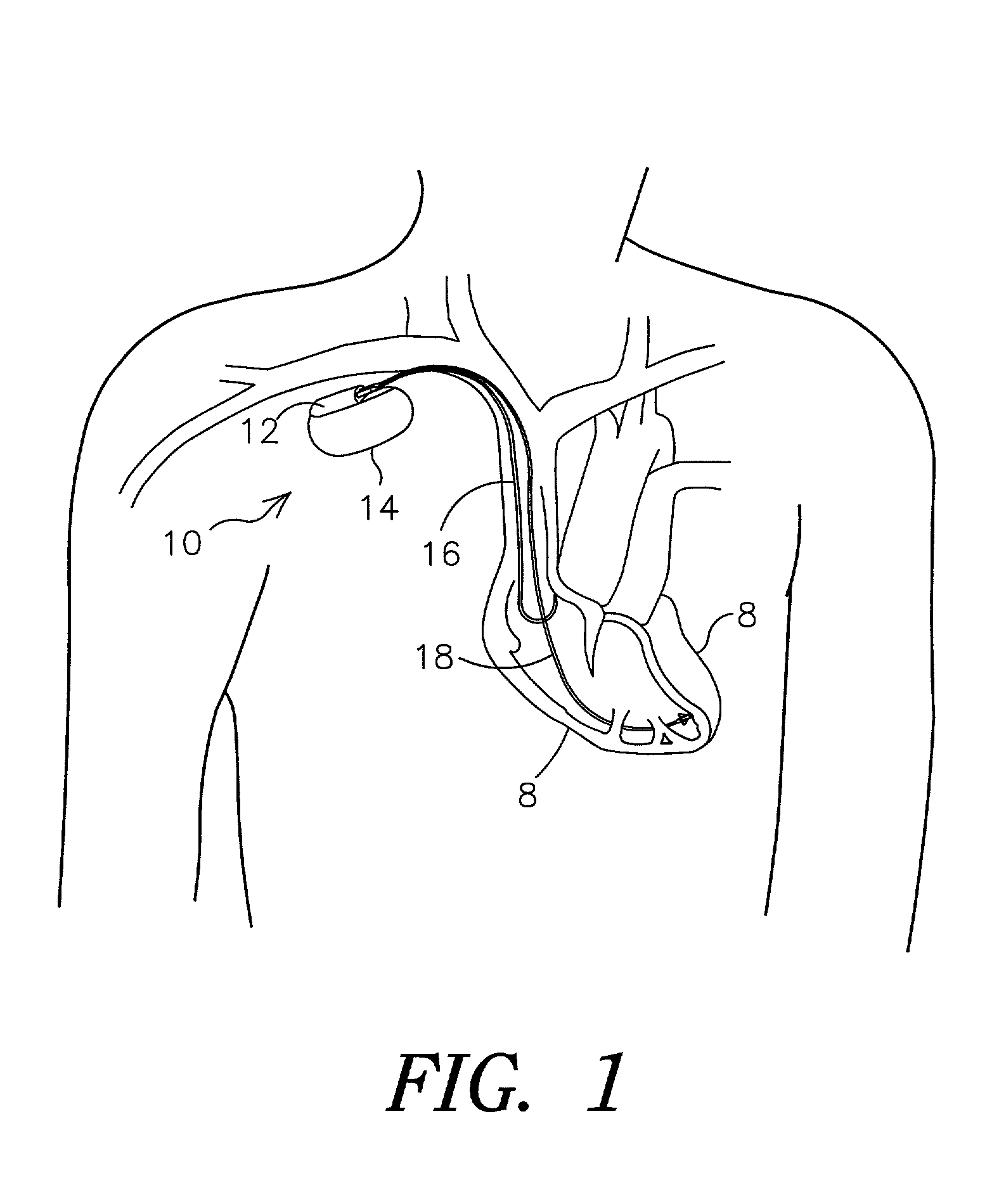 Methods for adjusting cardiac detection criteria and implantable medical devices using same