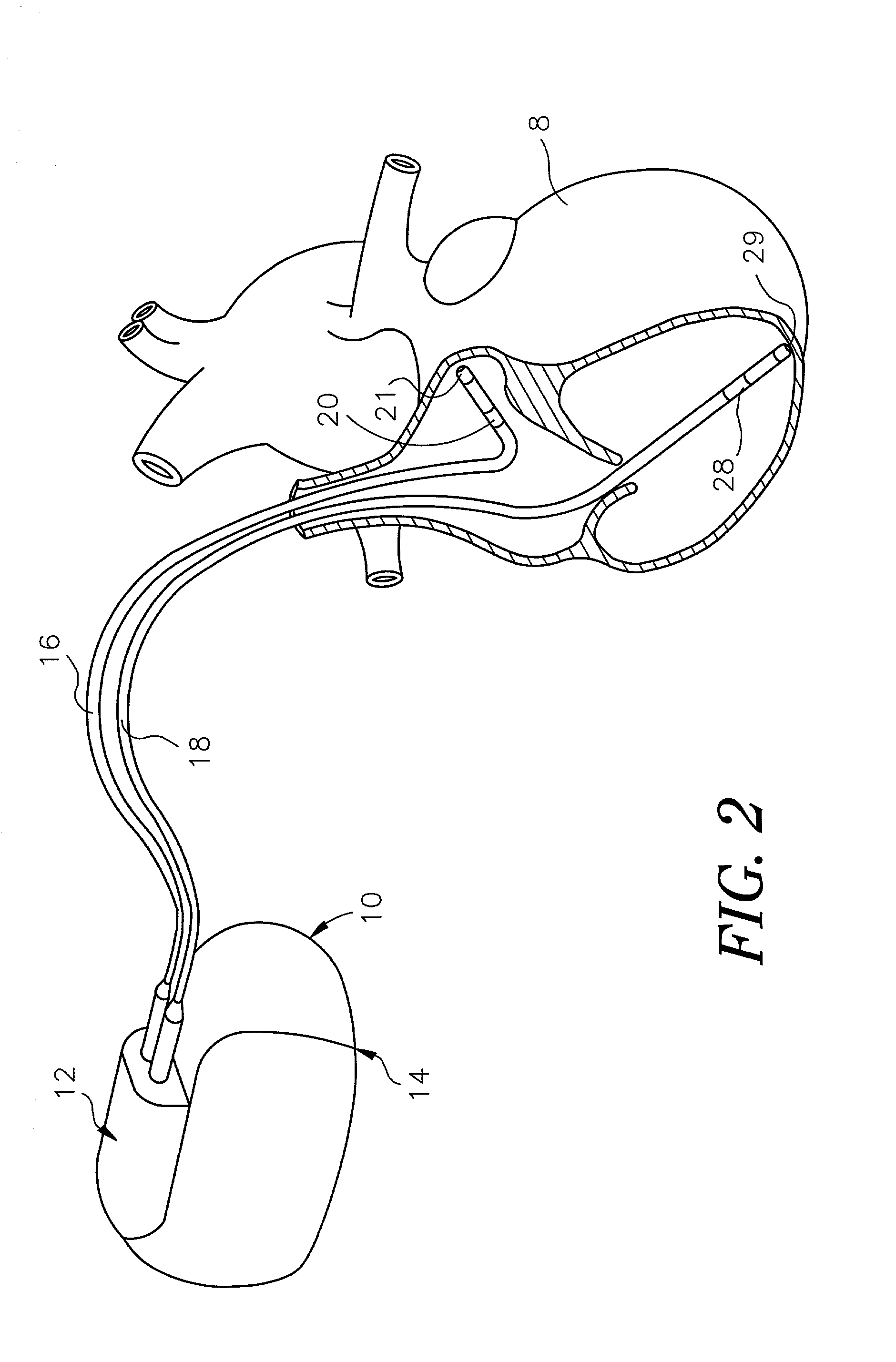 Methods for adjusting cardiac detection criteria and implantable medical devices using same