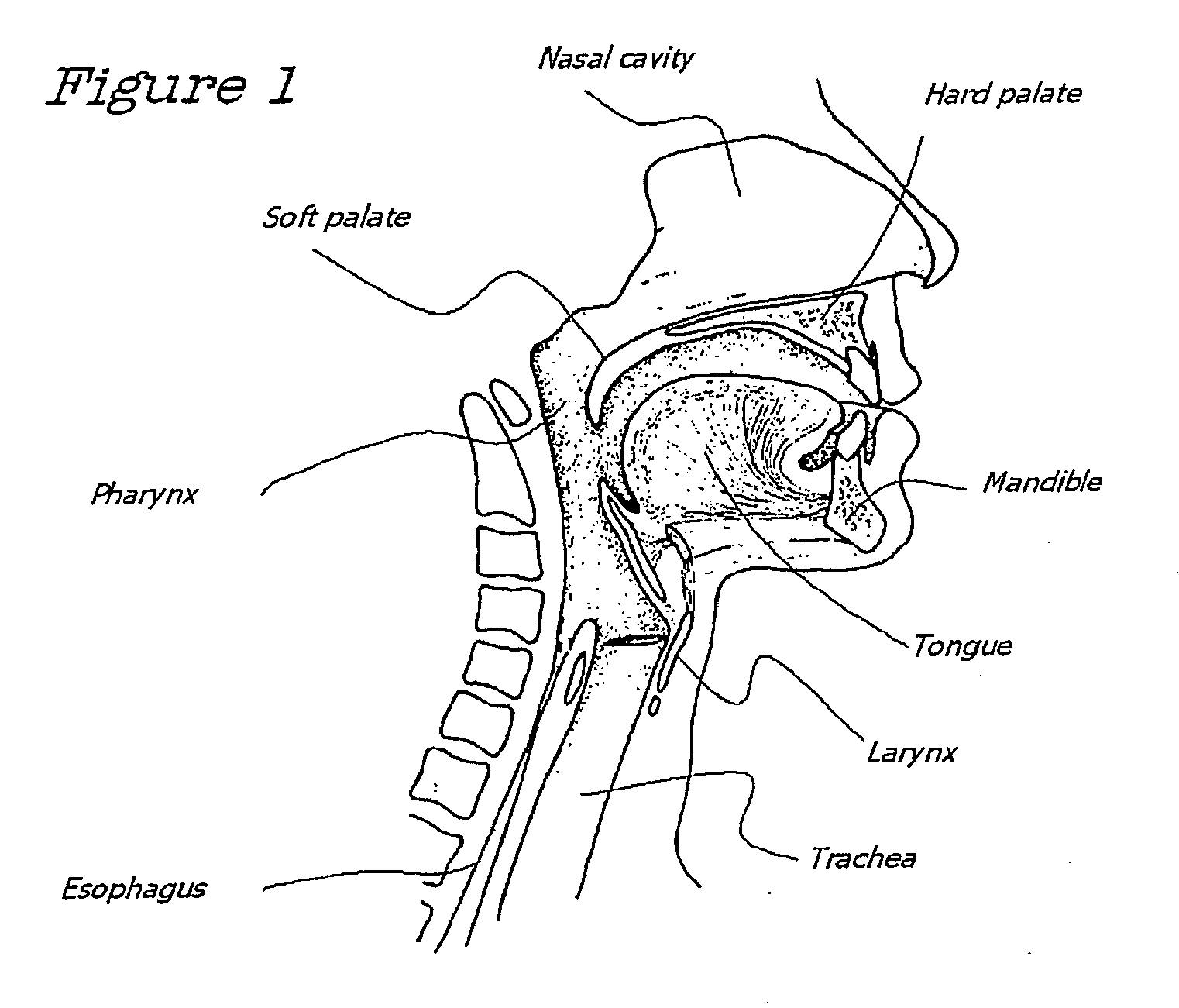 Method and Device for the Treatment of Obstructive Sleep Apnea and Snoring