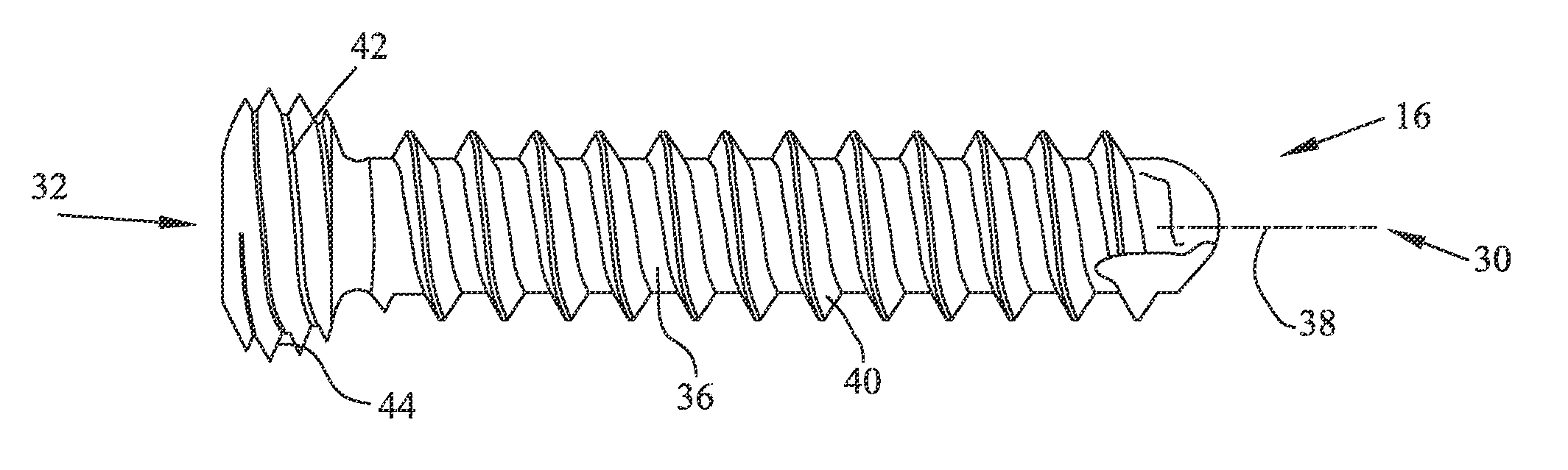 Anodized locking plate components