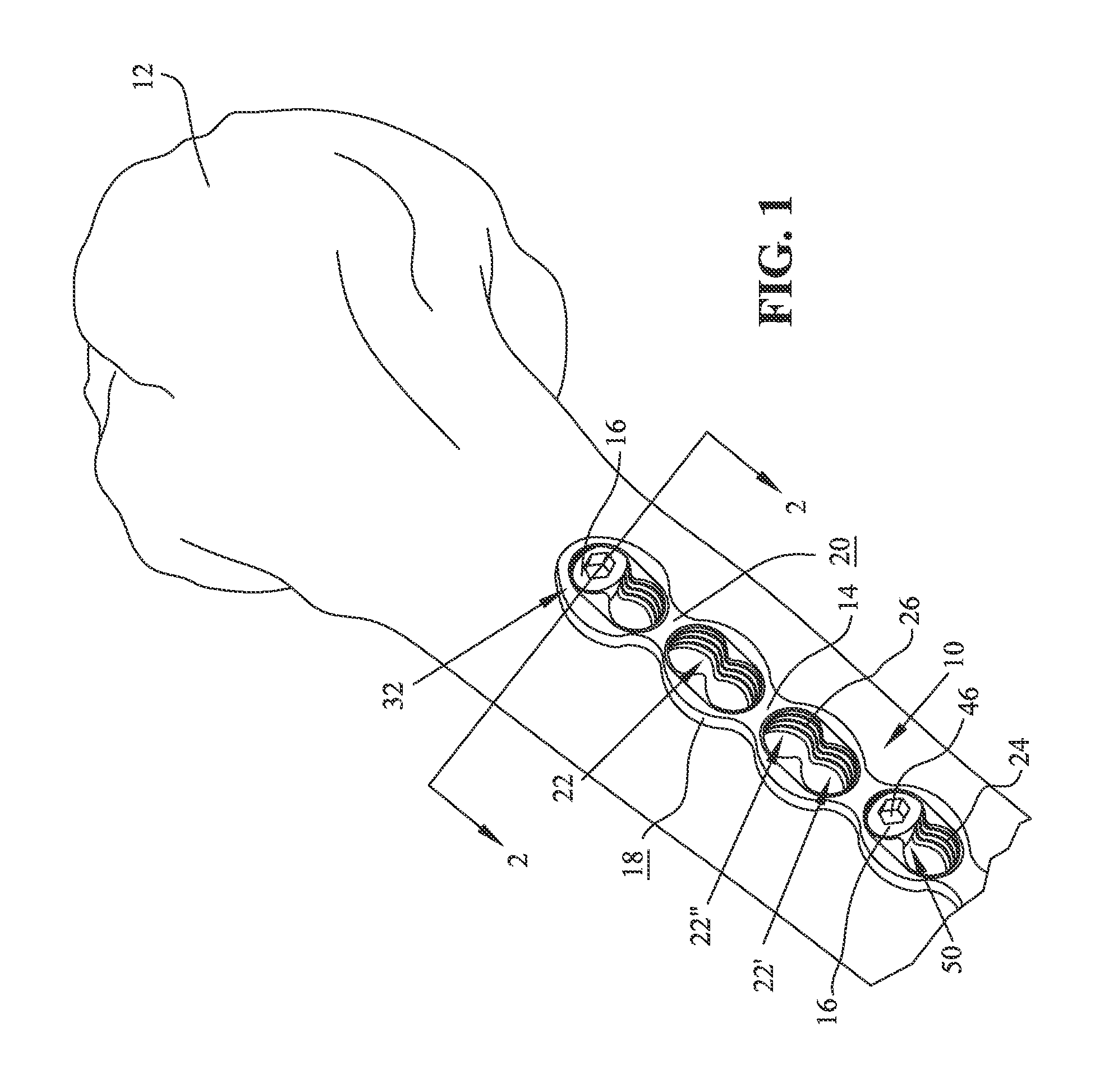 Anodized locking plate components