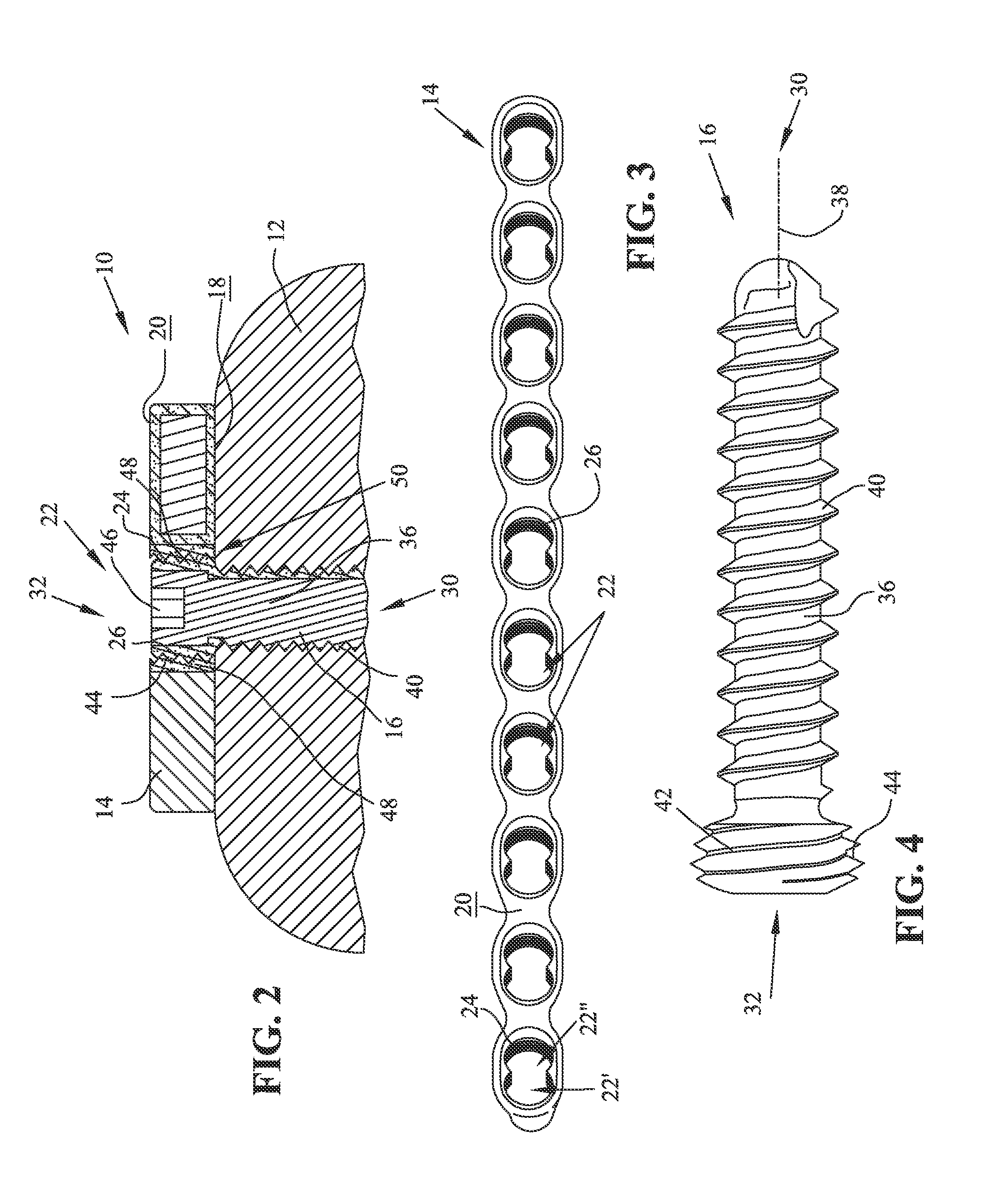 Anodized locking plate components