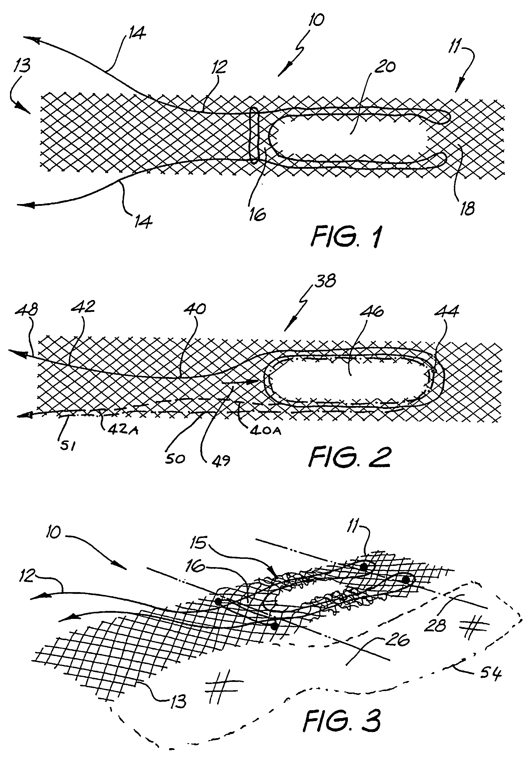 Treatment of vault prolapse