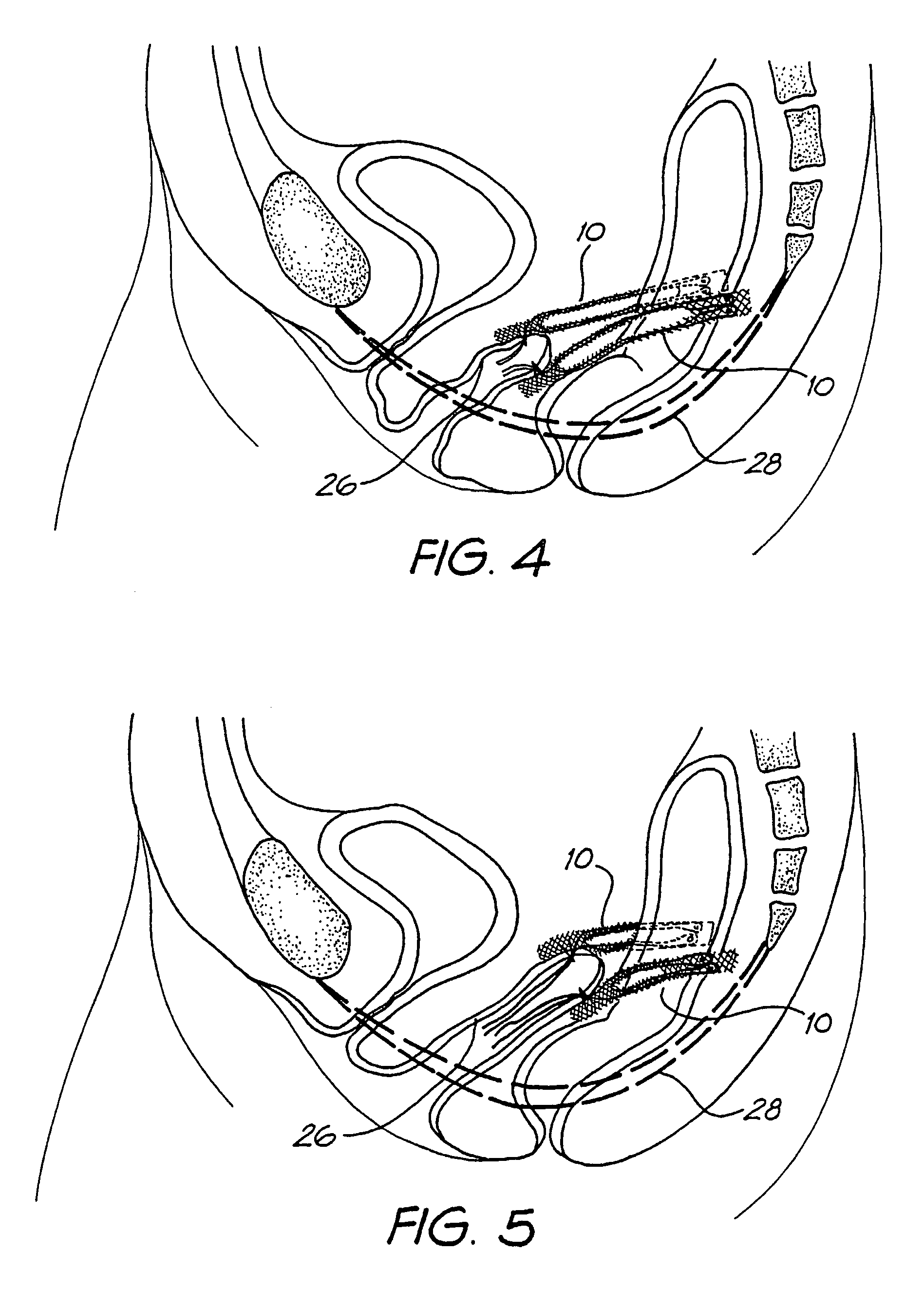 Treatment of vault prolapse