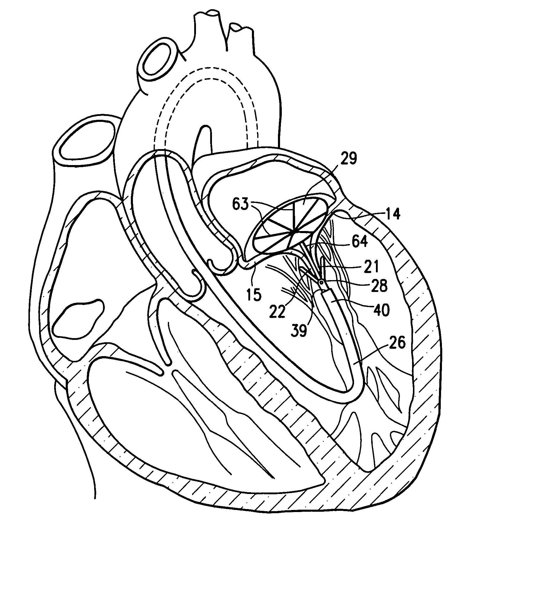 Percutaneous treatment for heart valves