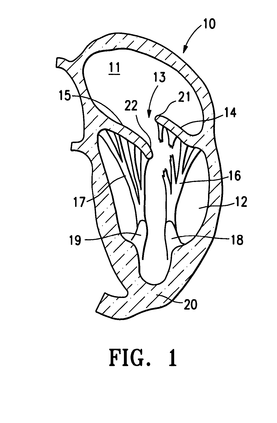 Percutaneous treatment for heart valves