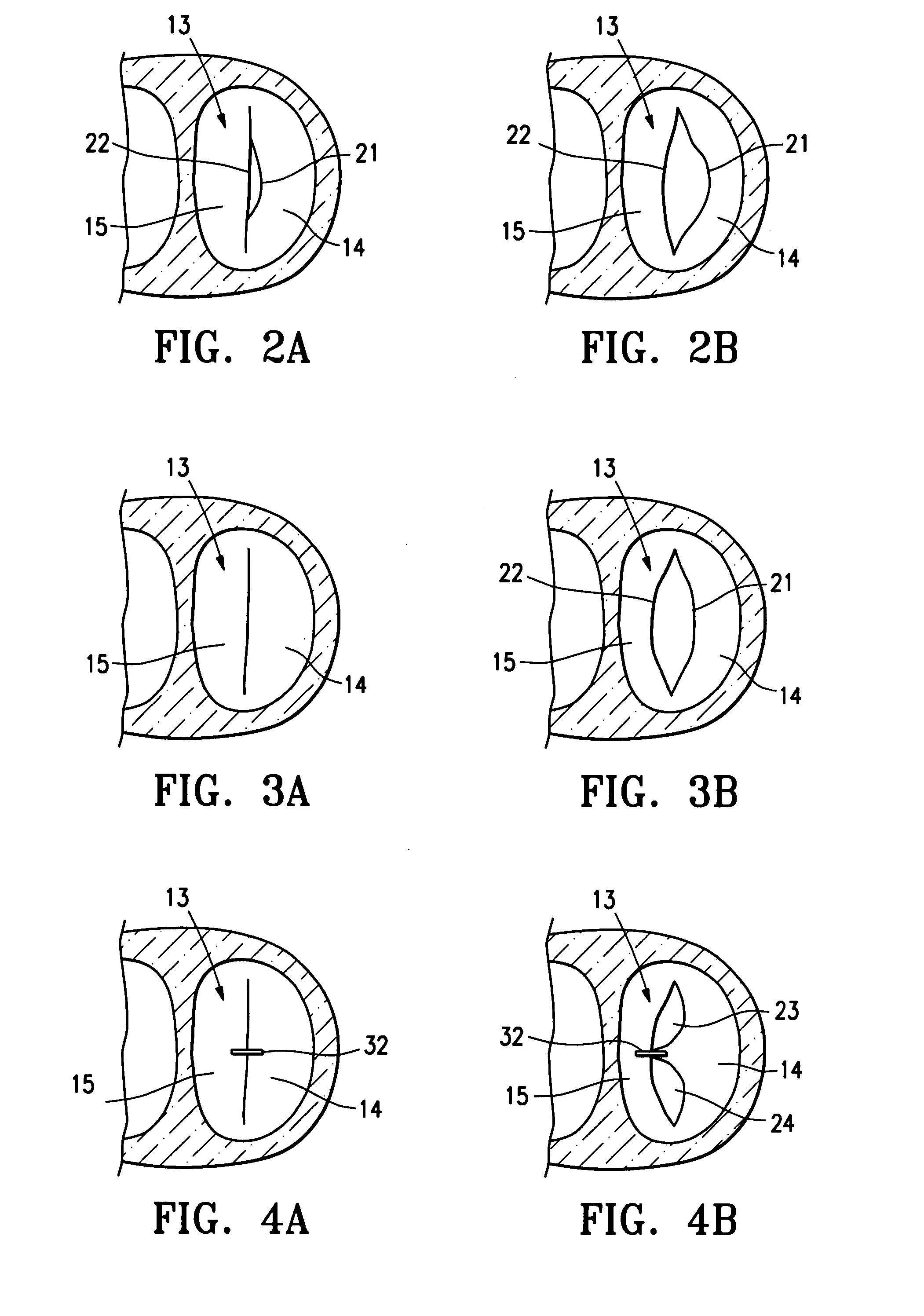 Percutaneous treatment for heart valves