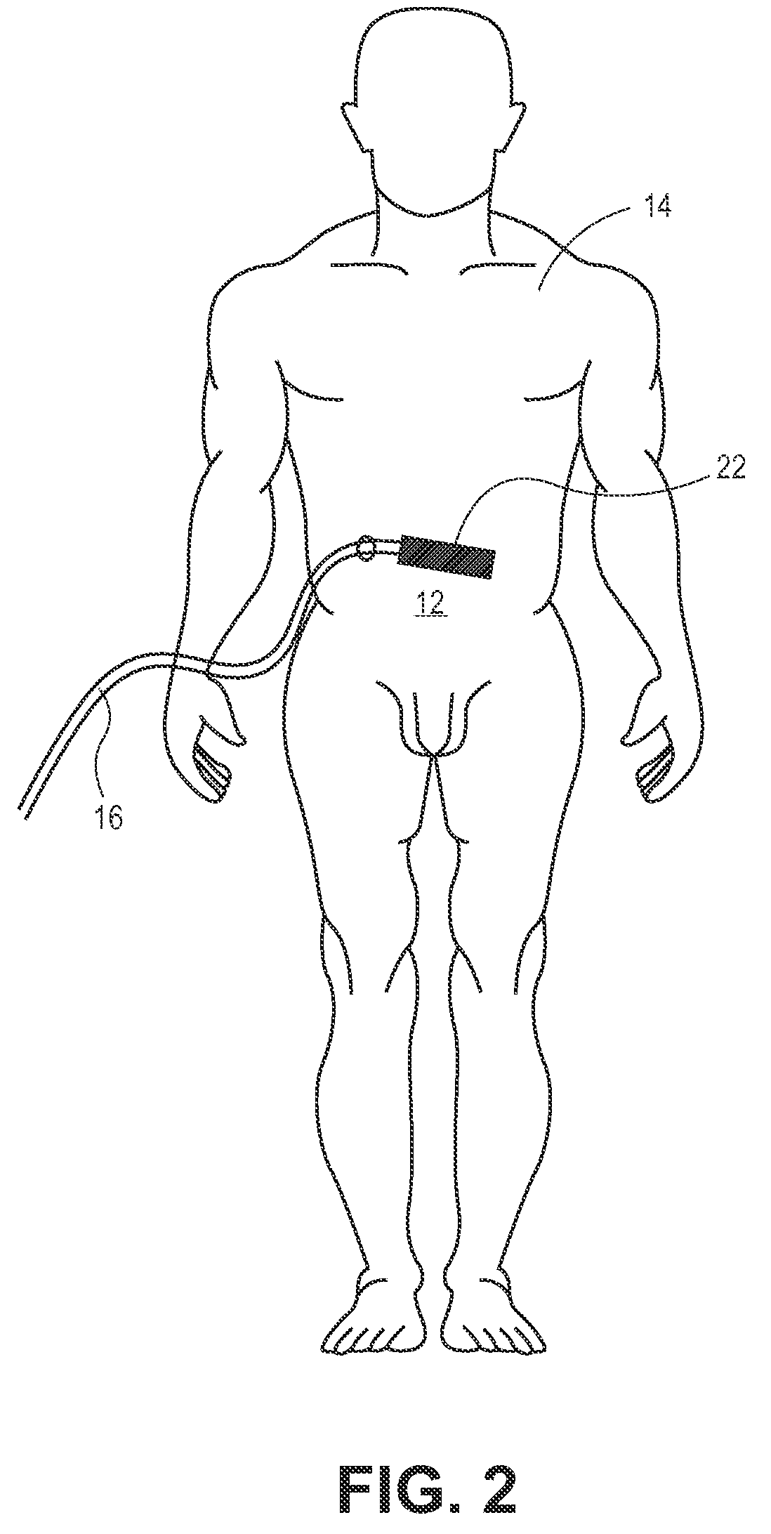 Hypothermia devices and methods