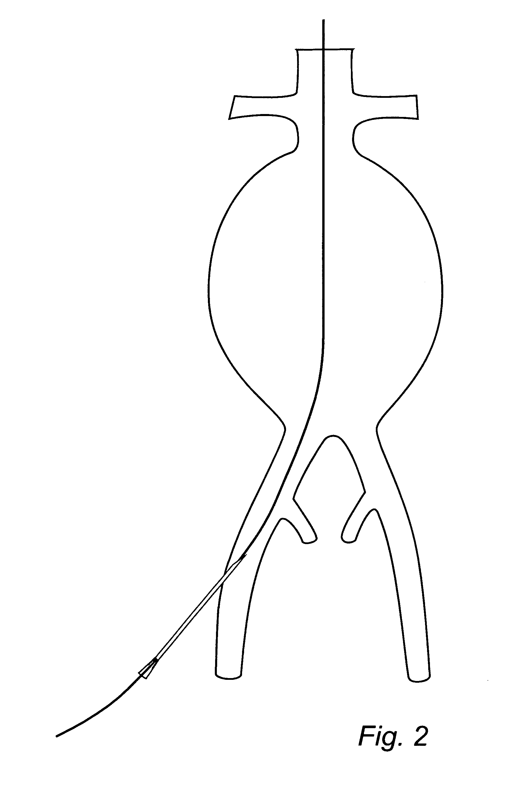 Device and method for treating ruptured aneurysms