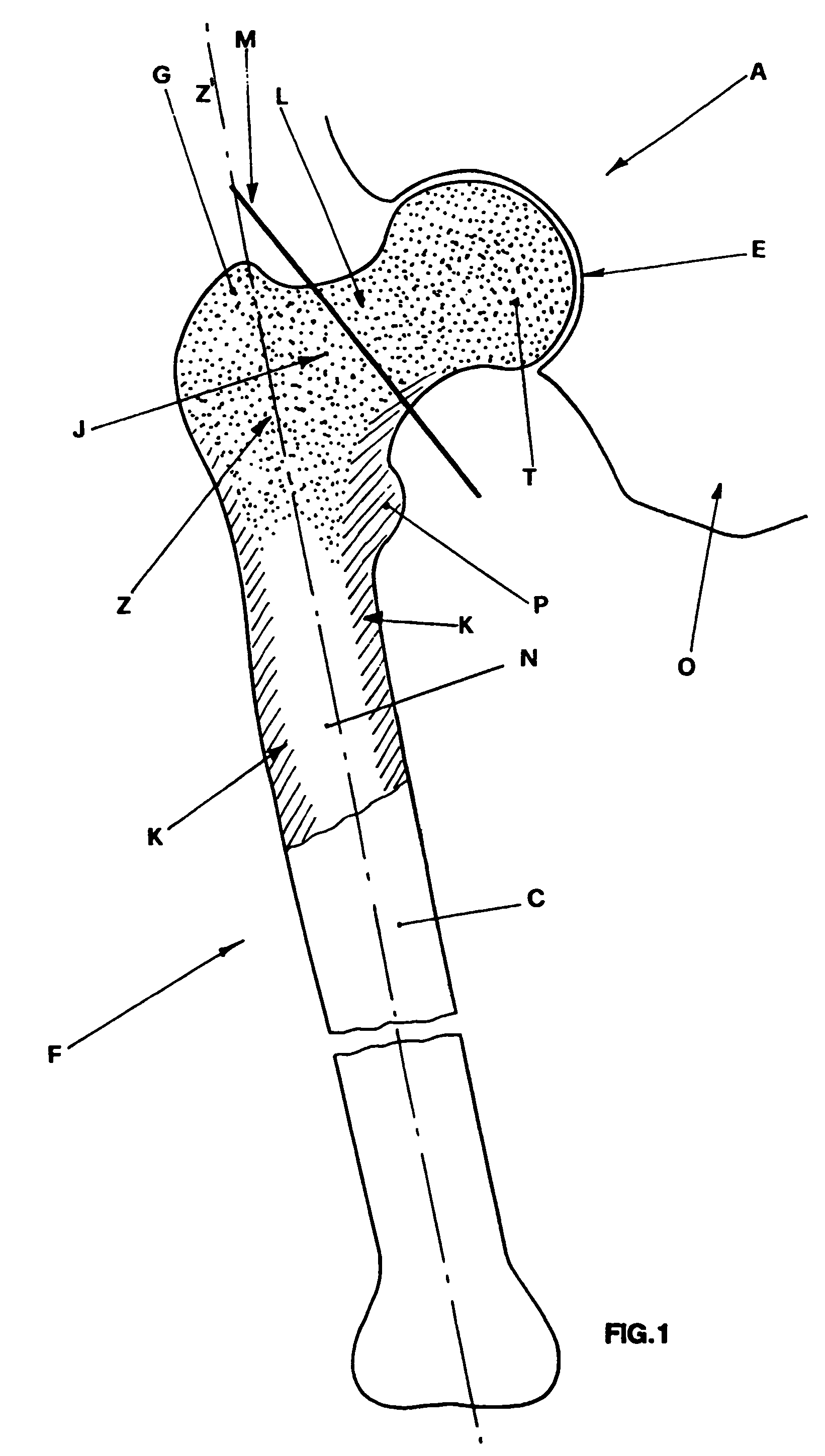 Femoral stem for hip prosthesis