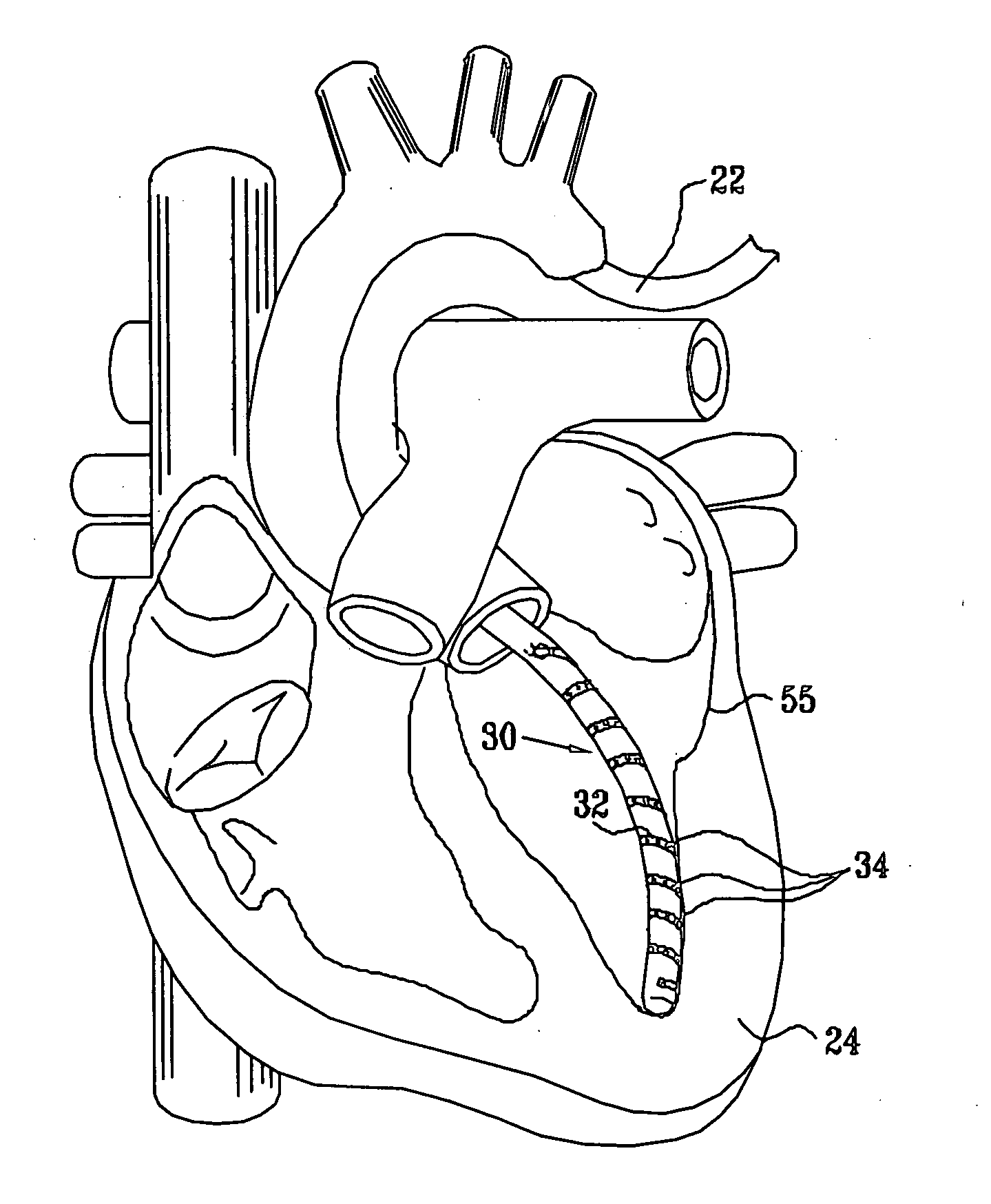 Catheter with electrode strip