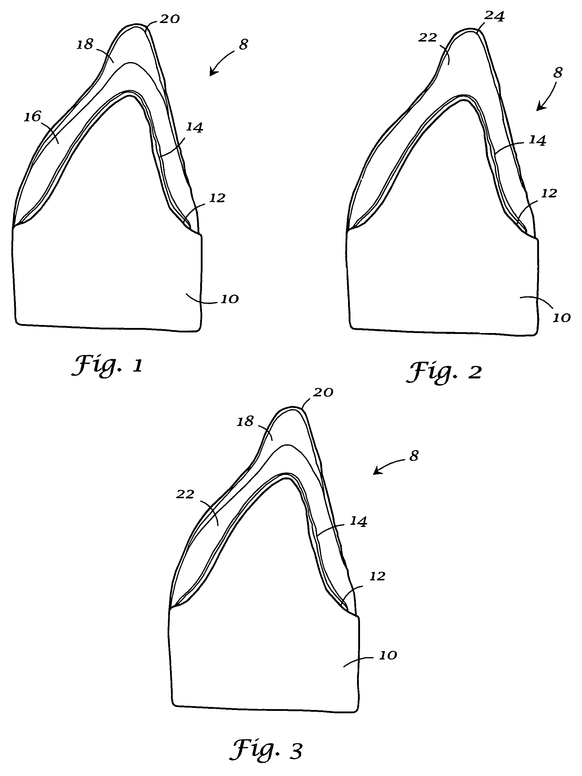 Integrated porcelain system for a dental prosthesis