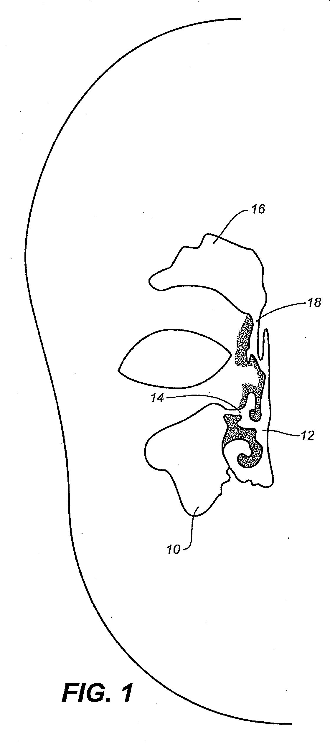 Device and methods for treating paranasal sinus conditions